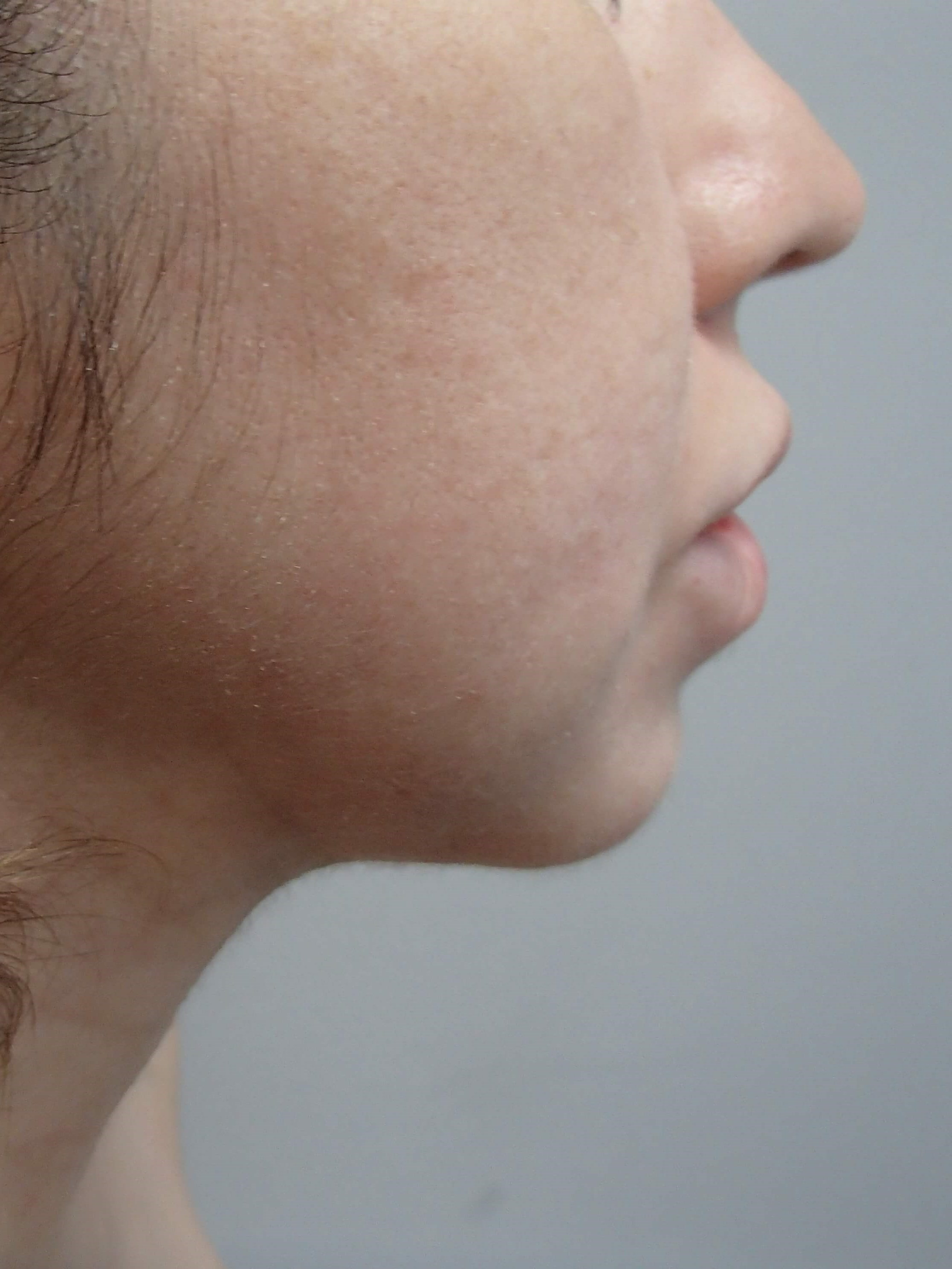 Chin Augmentation w/ Neck Lipo After