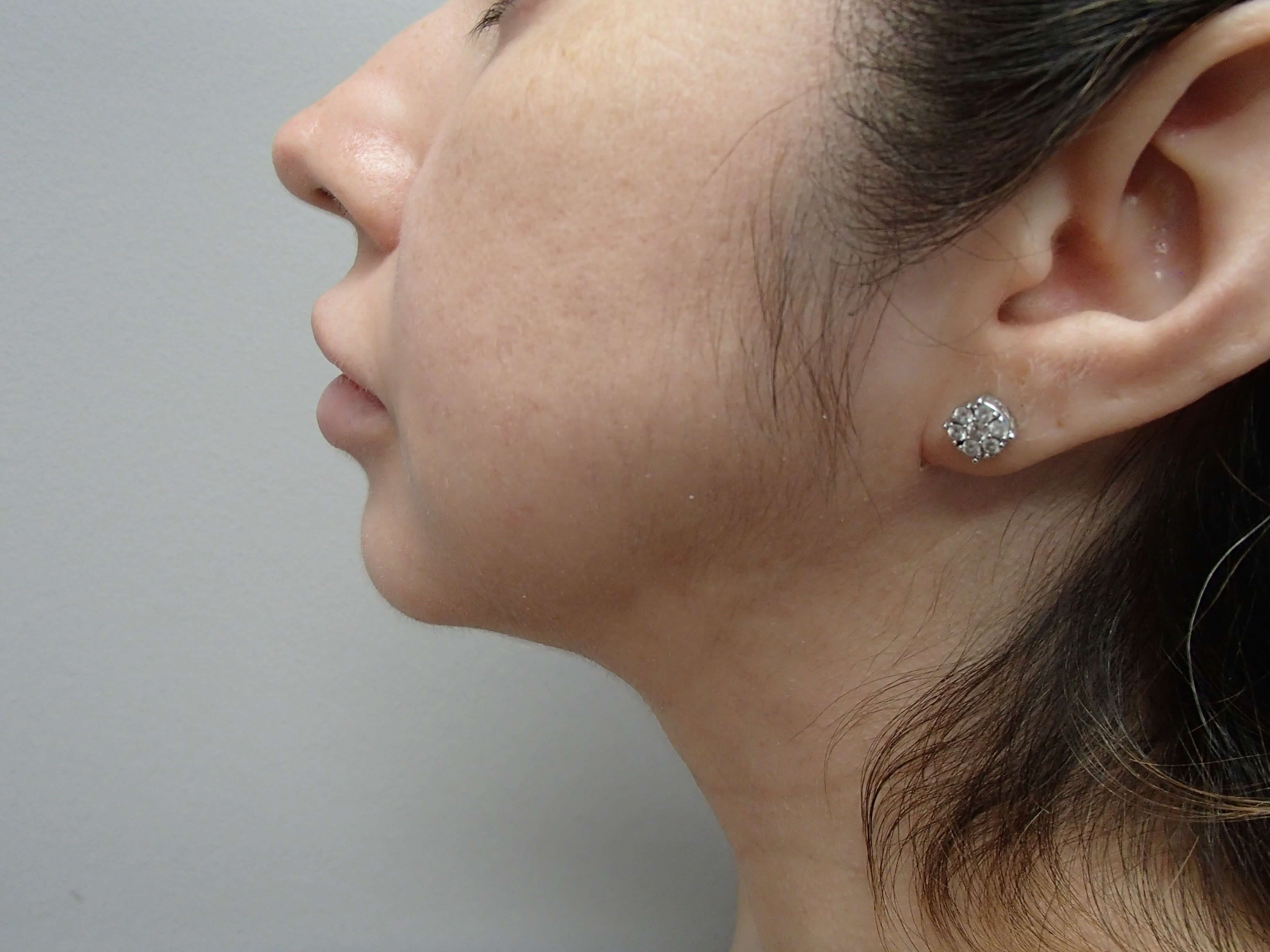 Neck Lipo w/ Chin Augmentation After