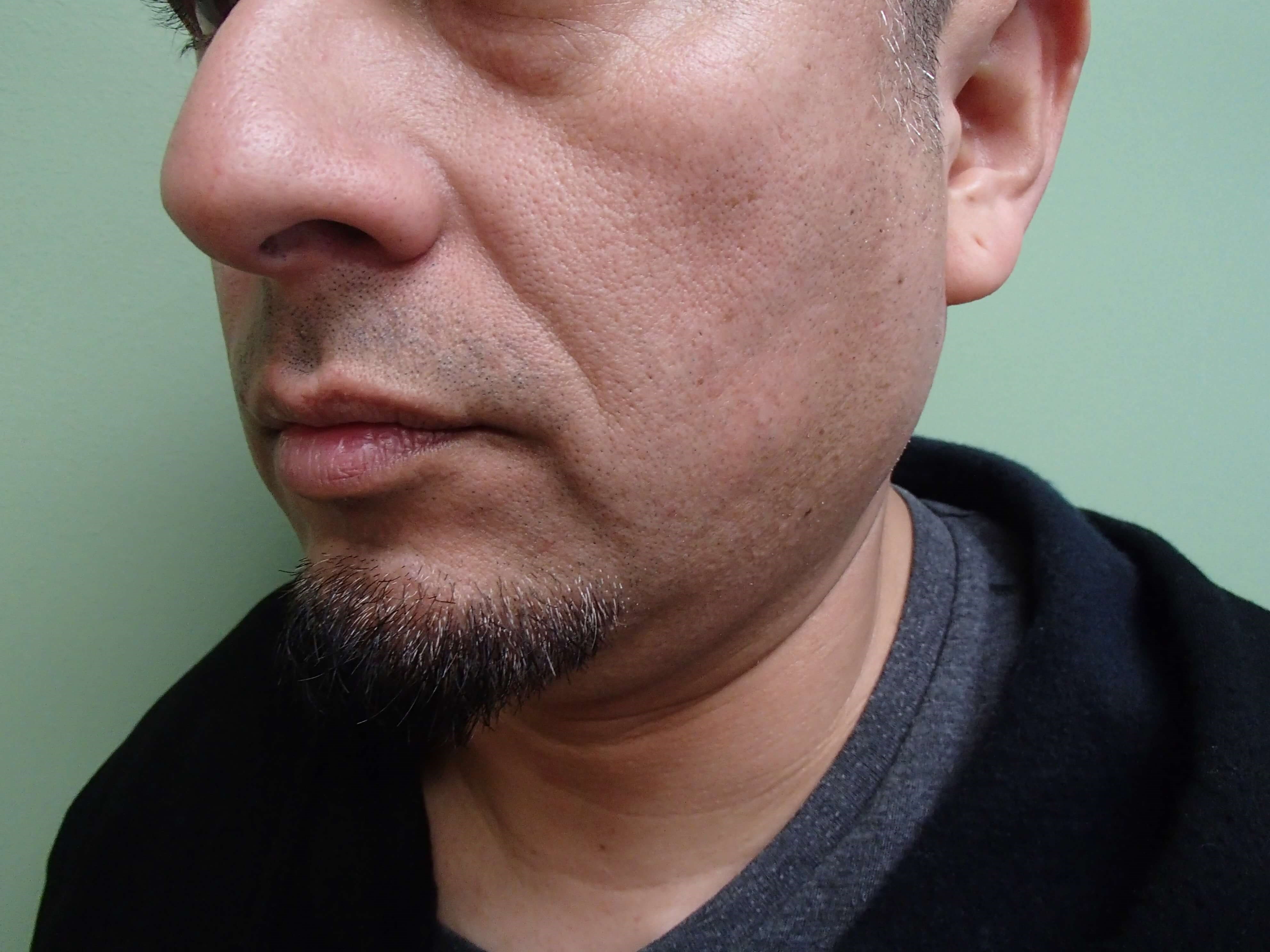 Neck Liposuction Before