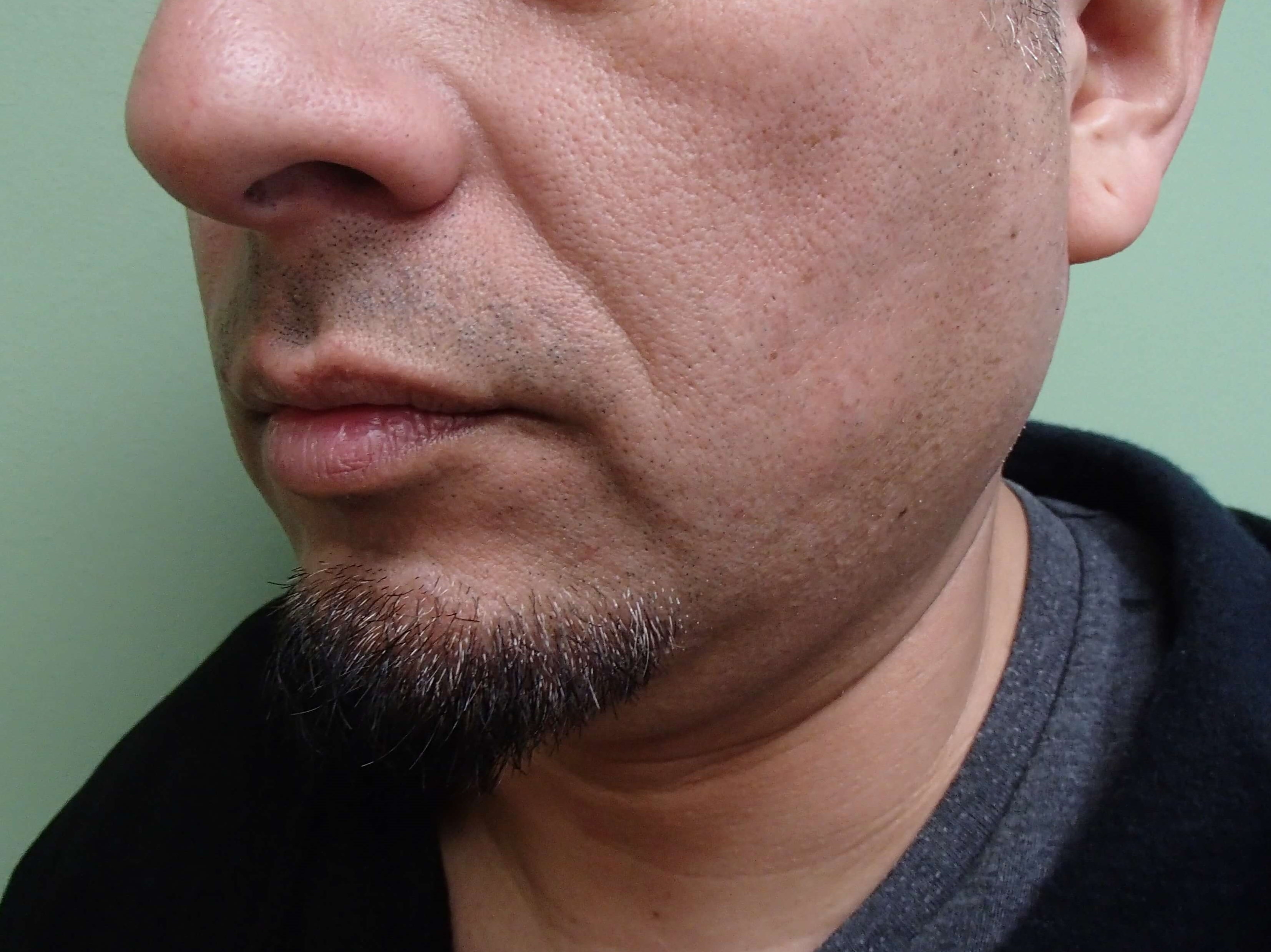 Neck Liposuction Before