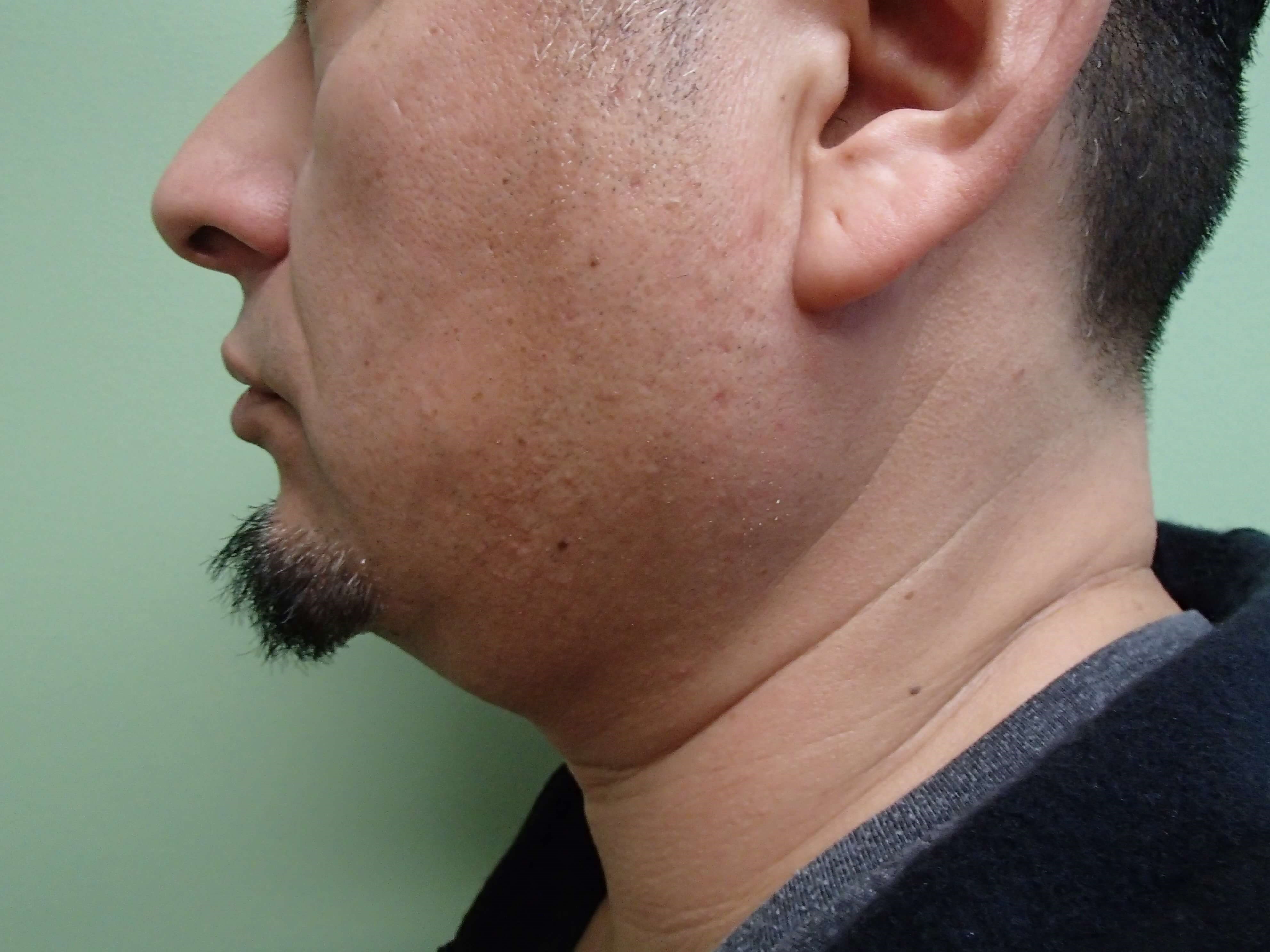 Neck Liposuction Before