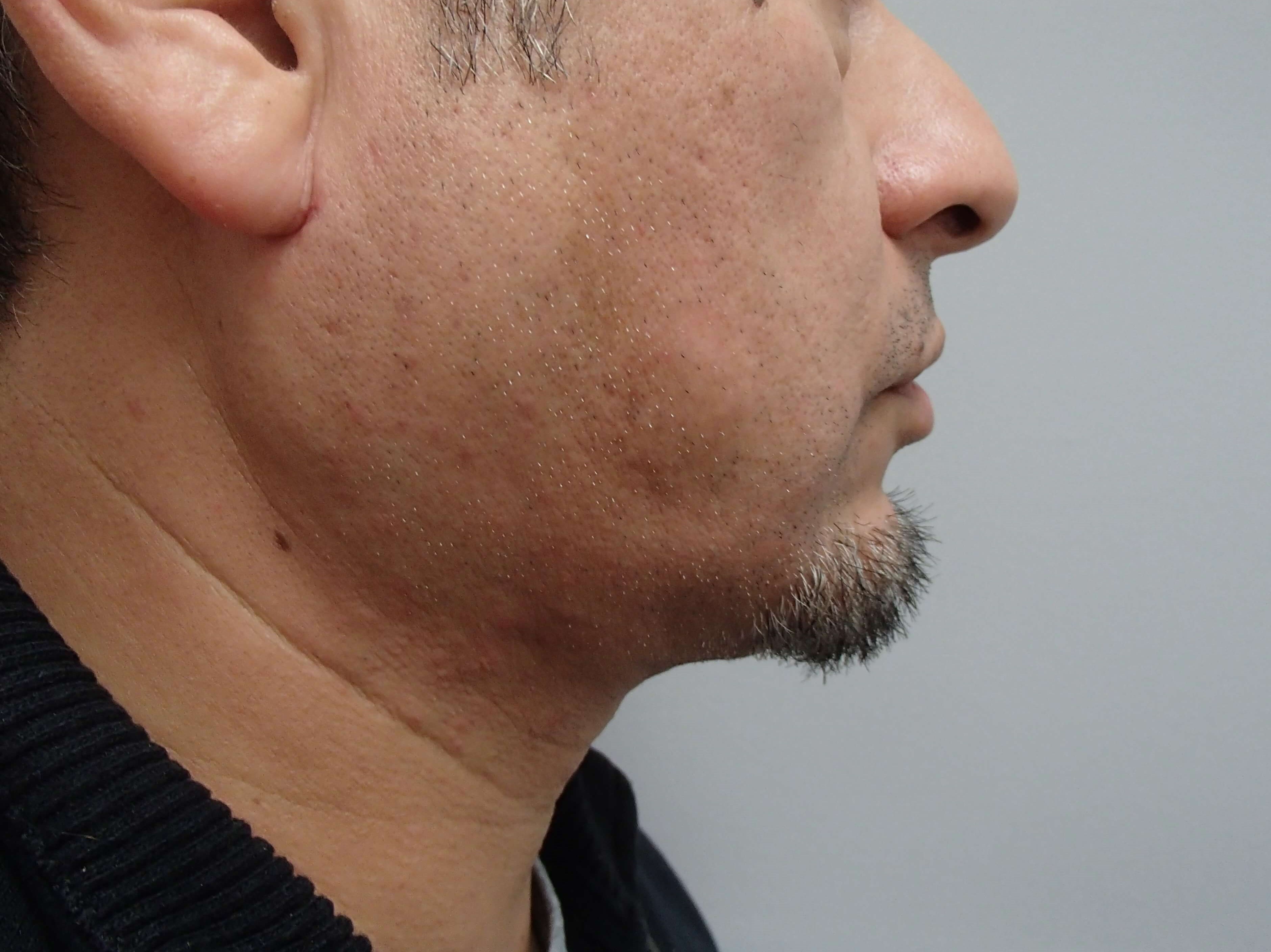 Neck Liposuction After
