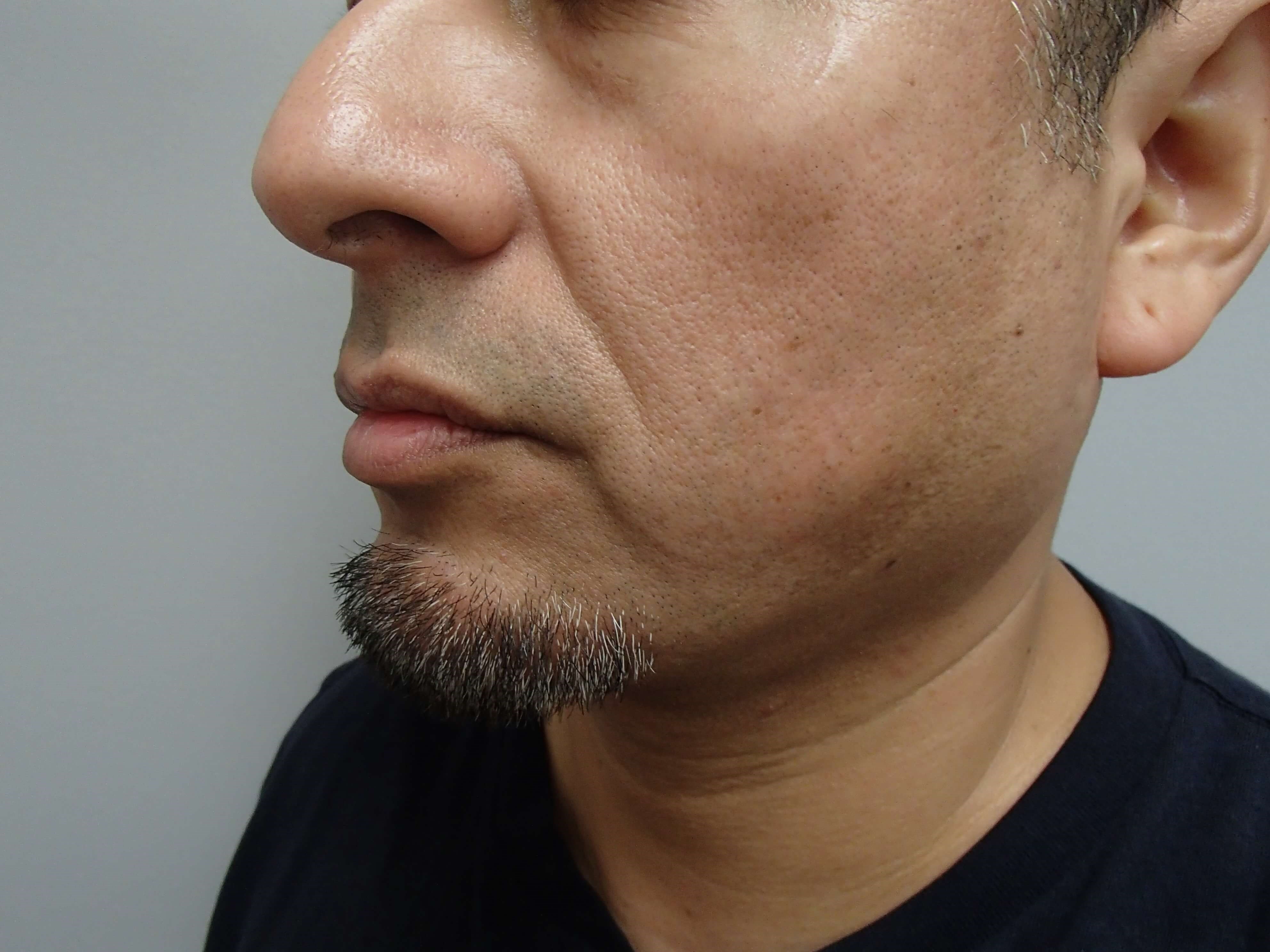 Neck Liposuction After