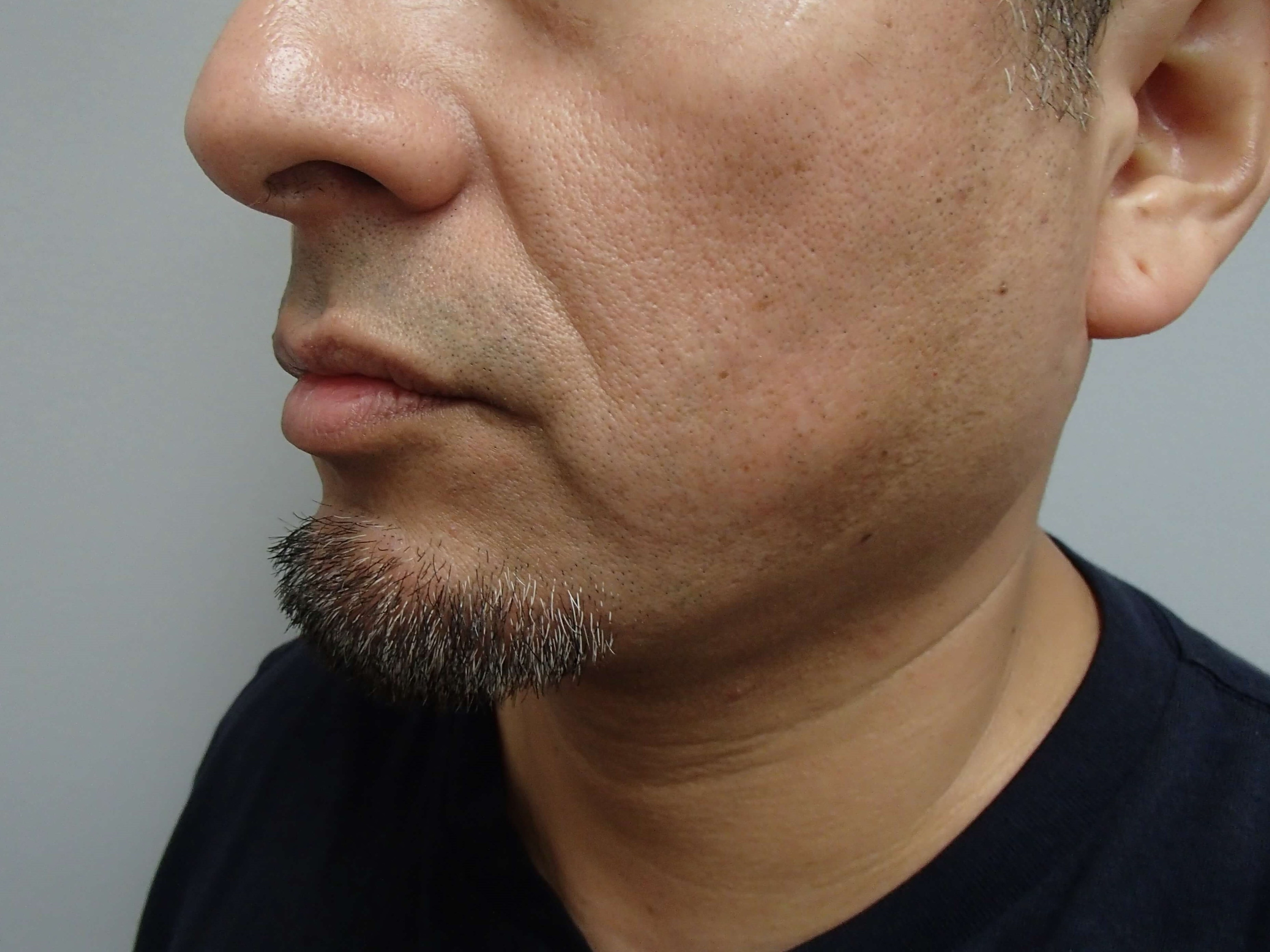 Neck Liposuction After
