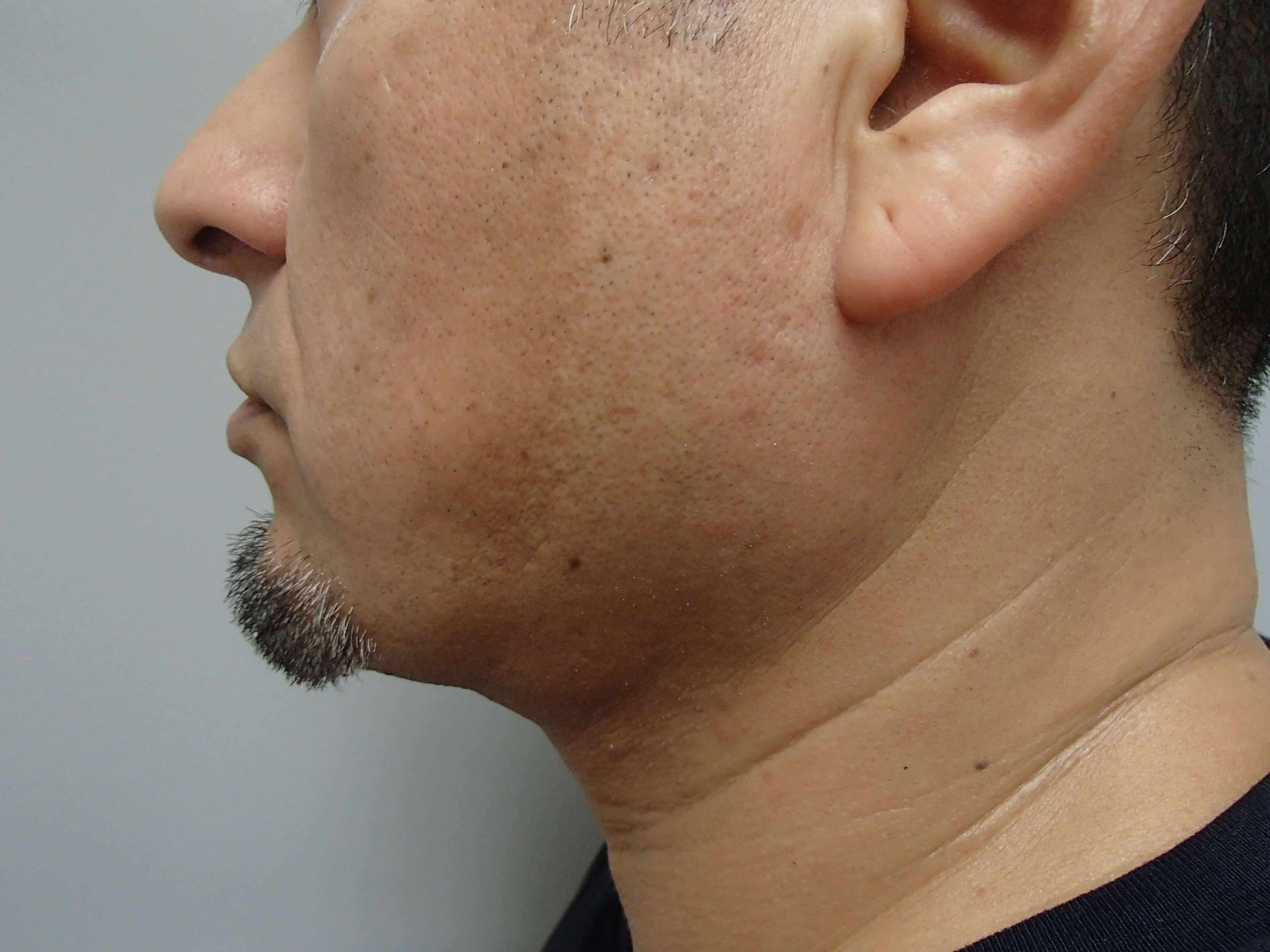 Neck Liposuction After
