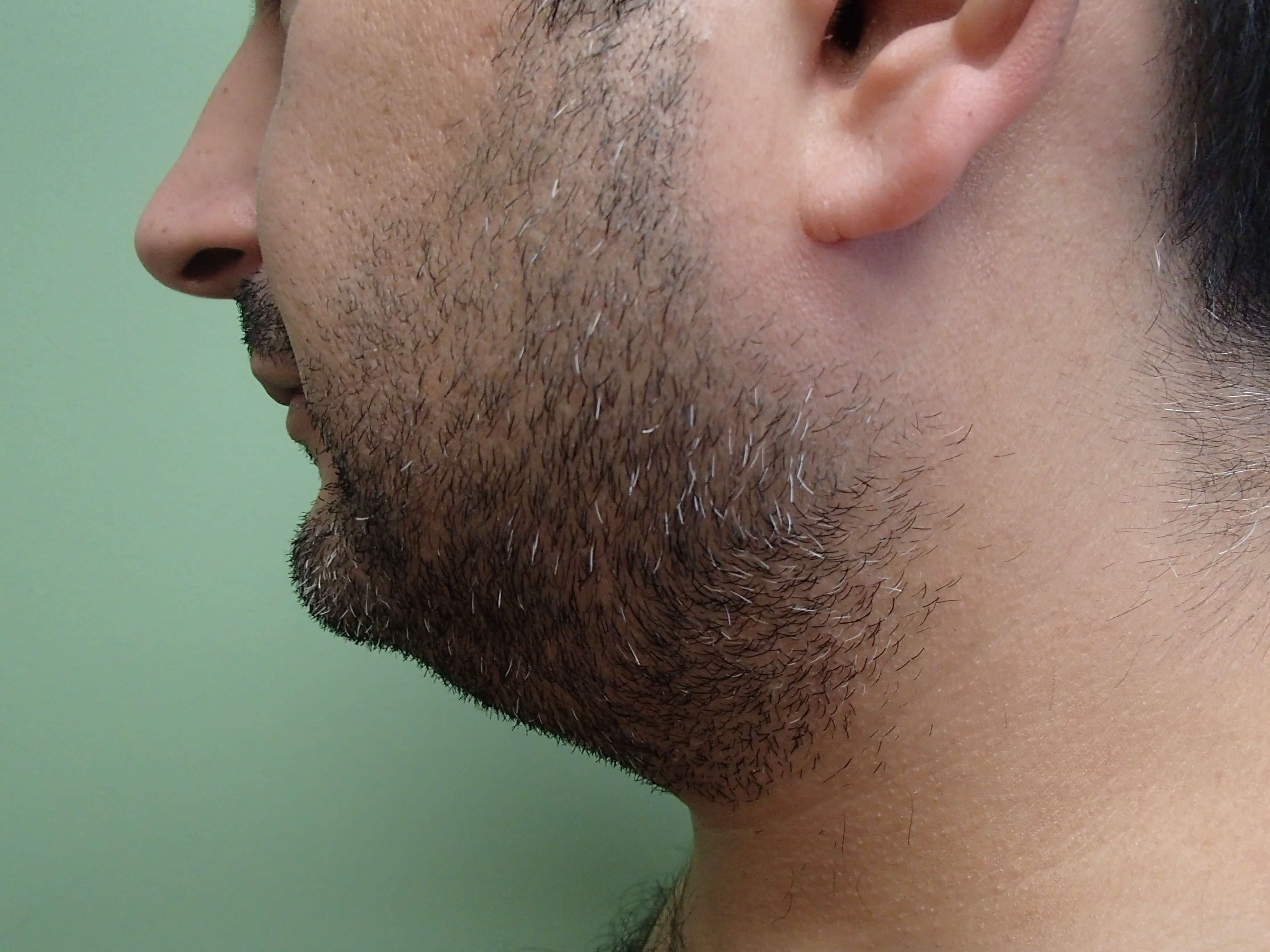 Neck Liposuction Before