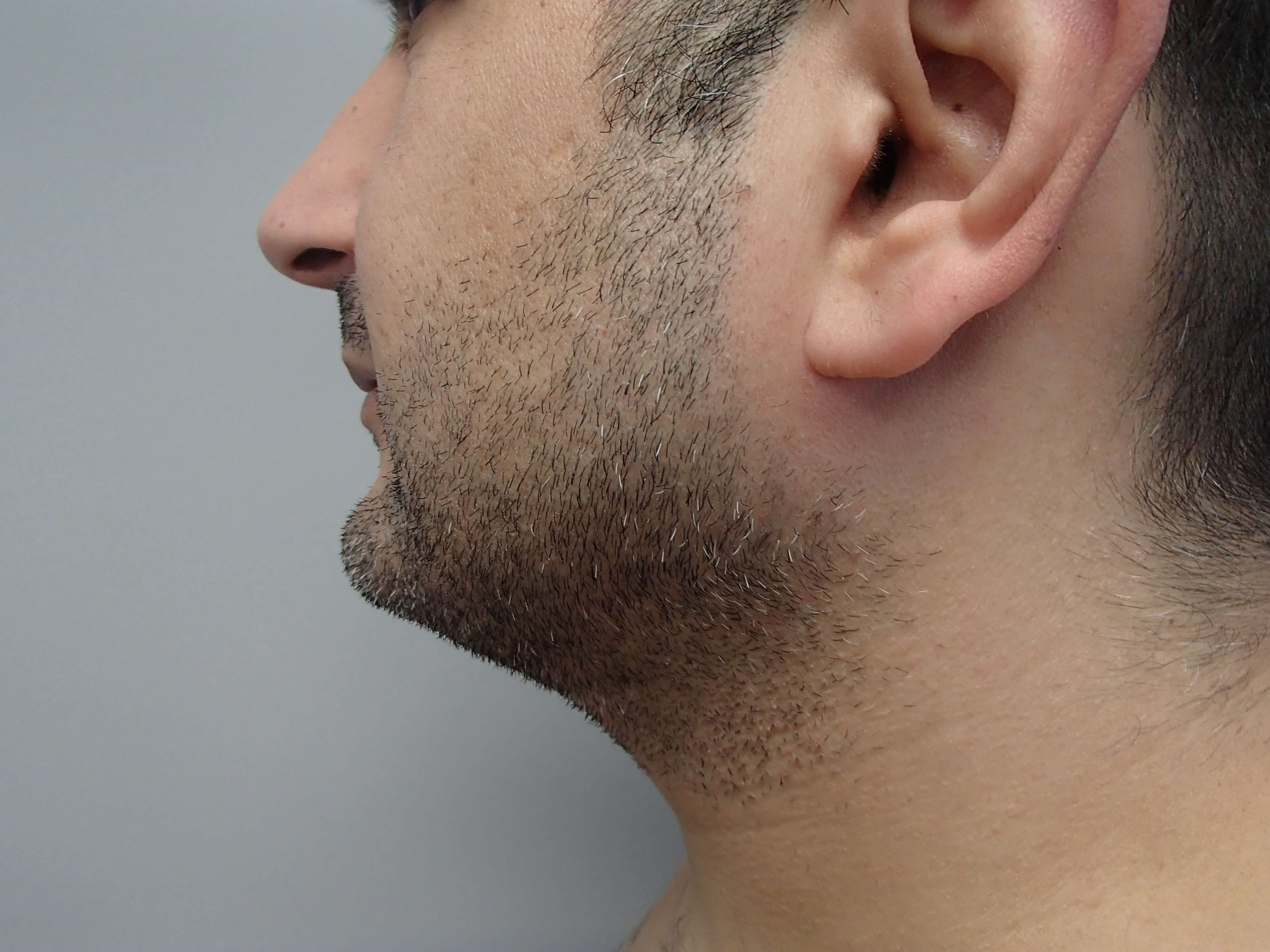 Neck Liposuction After