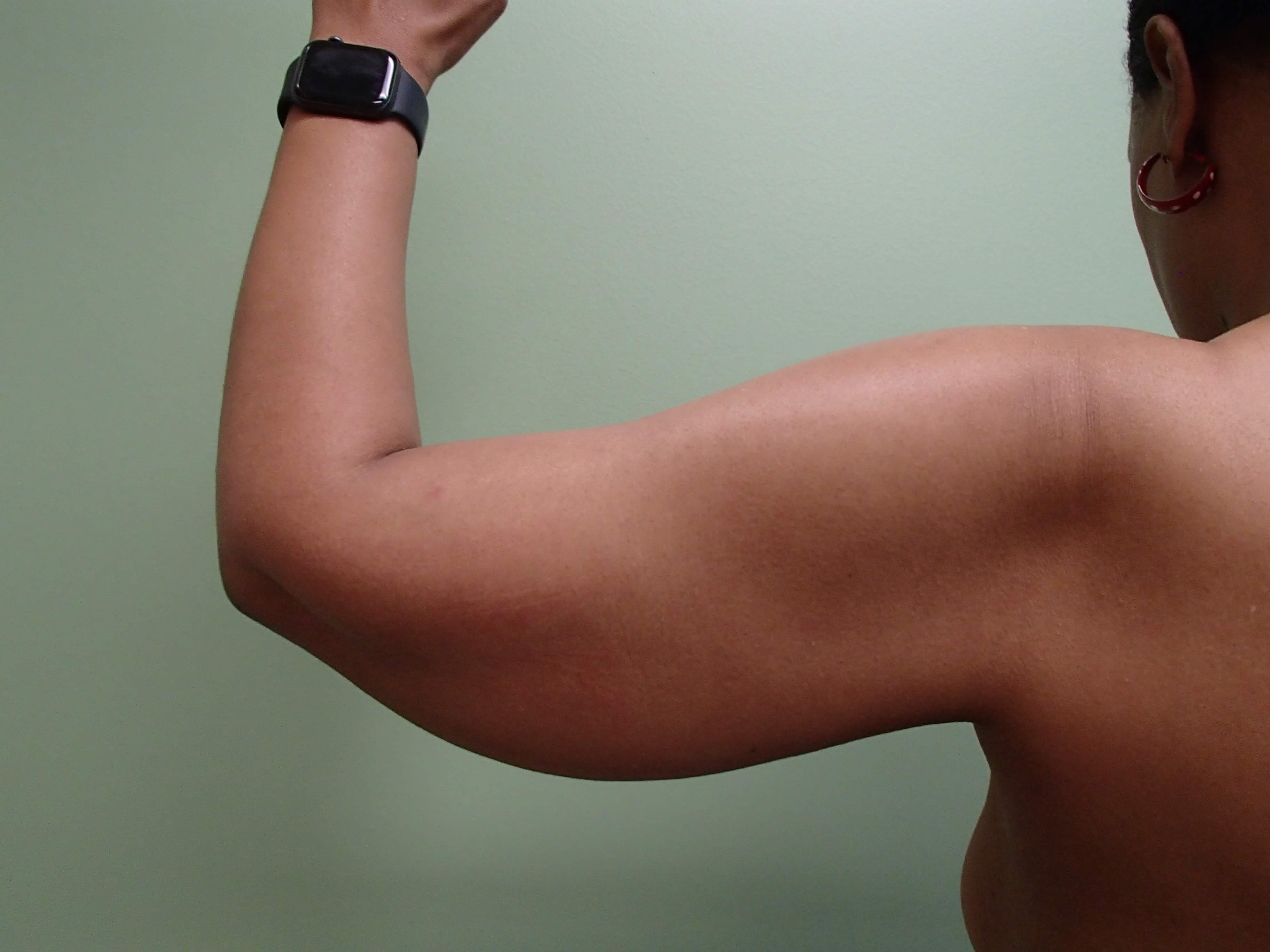 Arm Lift (Brachioplasty) Before