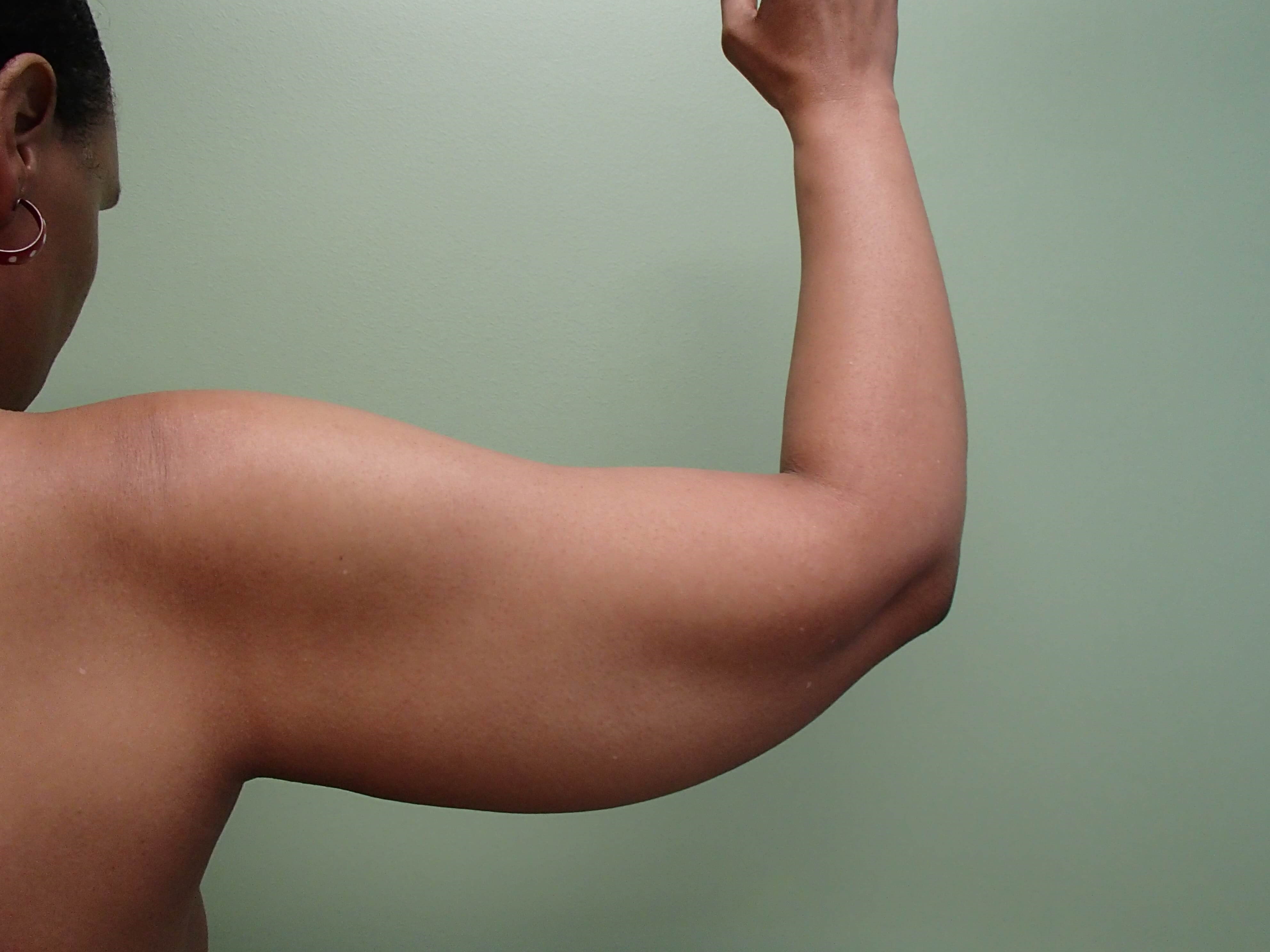 Arm Lift (Brachioplasty) Before