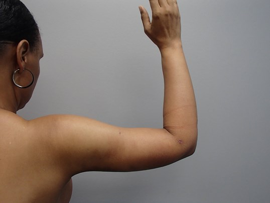 Arm Lift (Brachioplasty) After