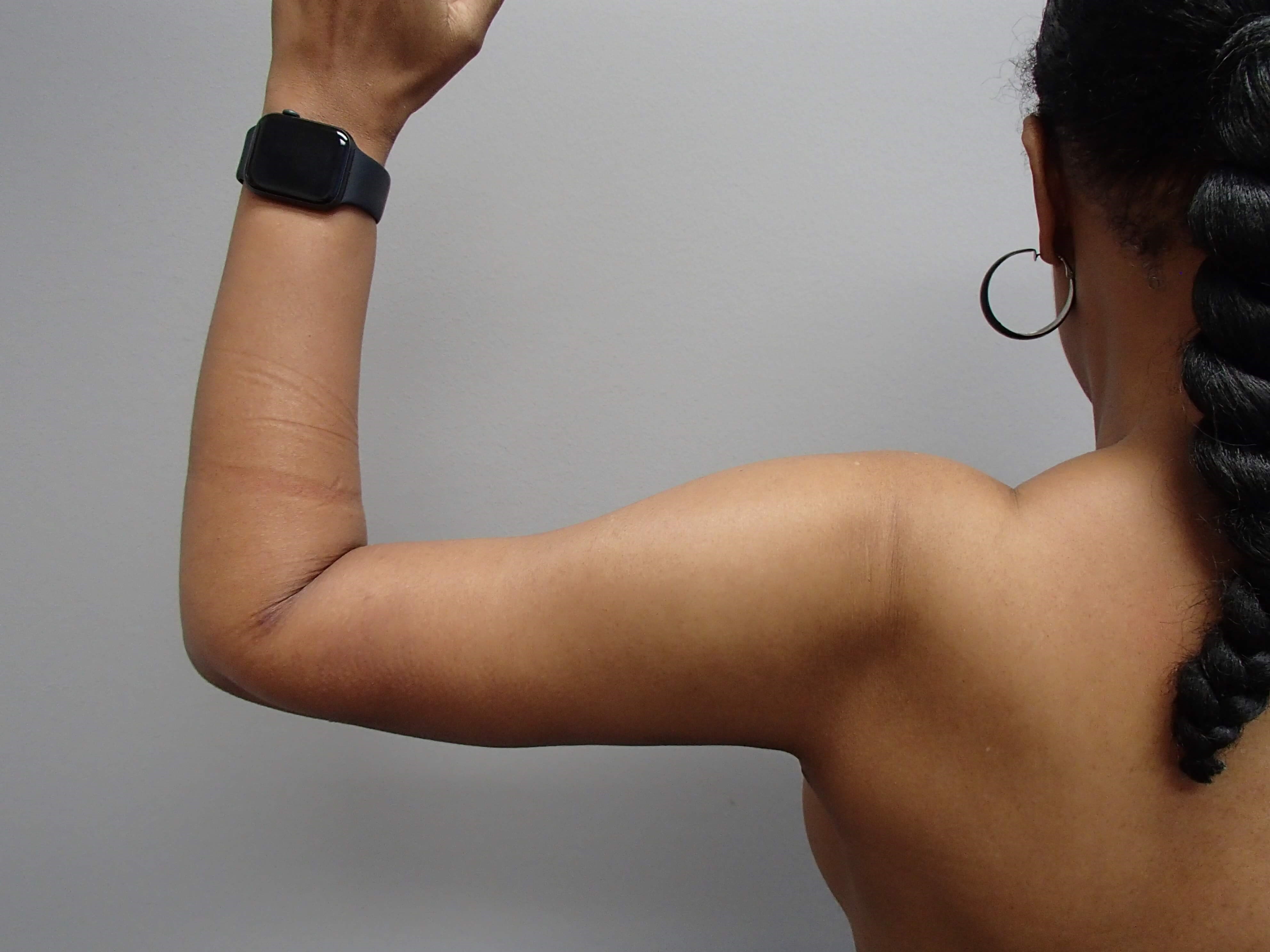 Arm Lift (Brachioplasty) After