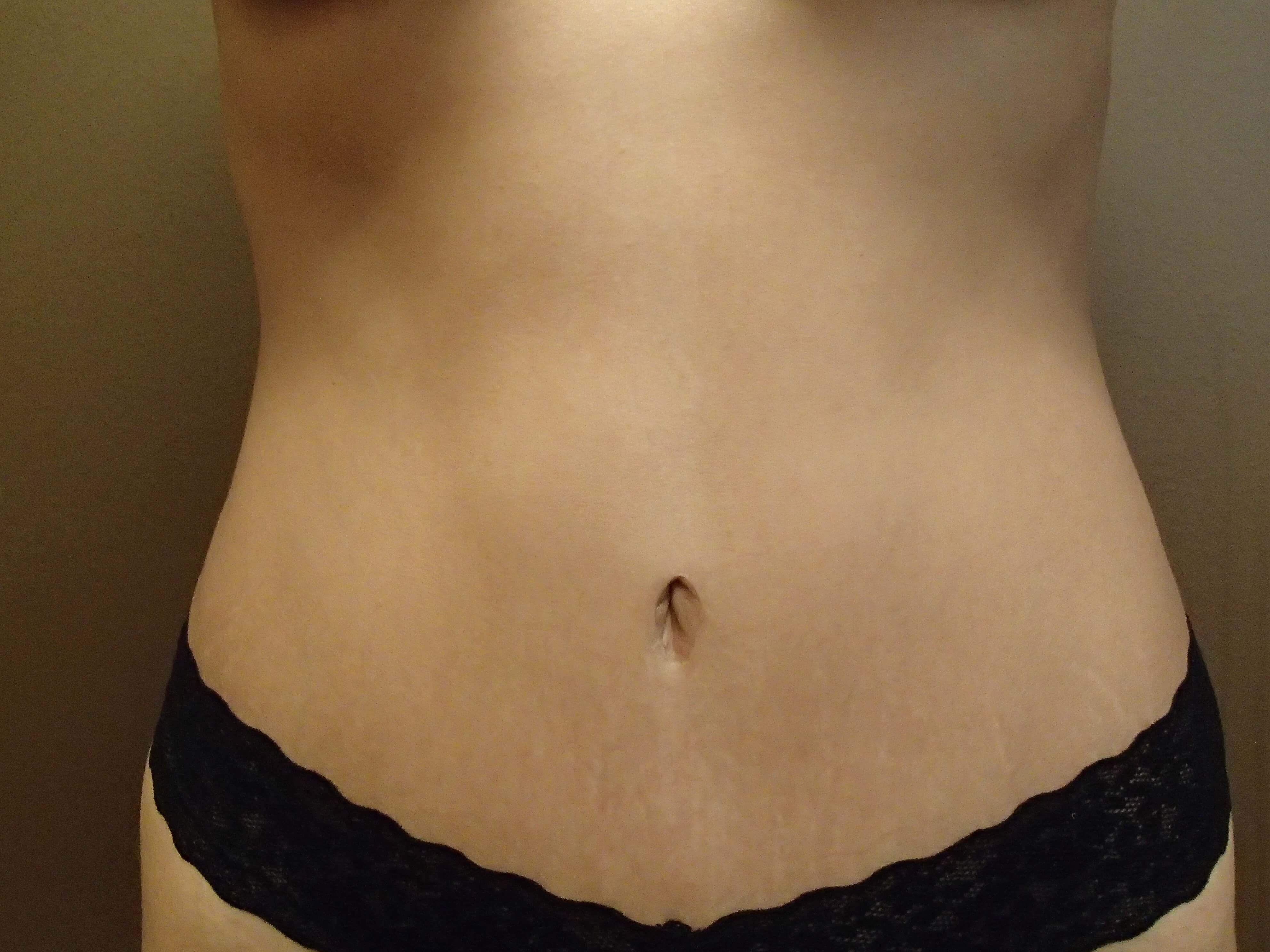 Timeless Tuck - Abdominoplasty After