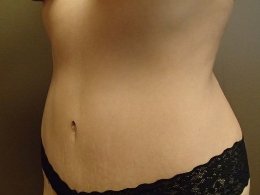 Timeless Tuck - Abdominoplasty After