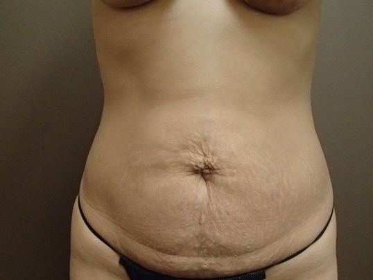 Timeless Tuck - Abdominoplasty Before