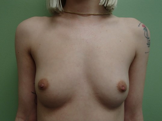 Breast Augmentation- Silicone Before
