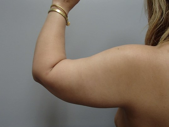 Arm Lift - Brachioplasty After