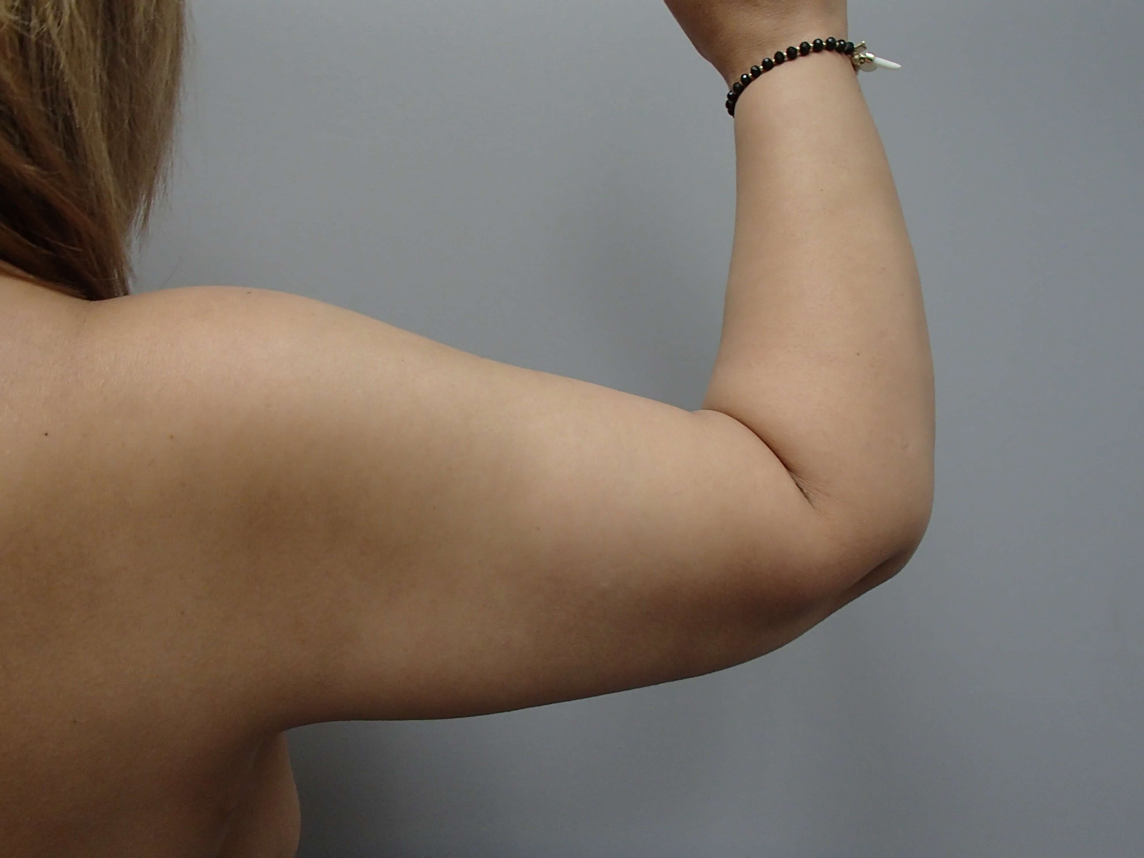 Arm Lift - Brachioplasty After