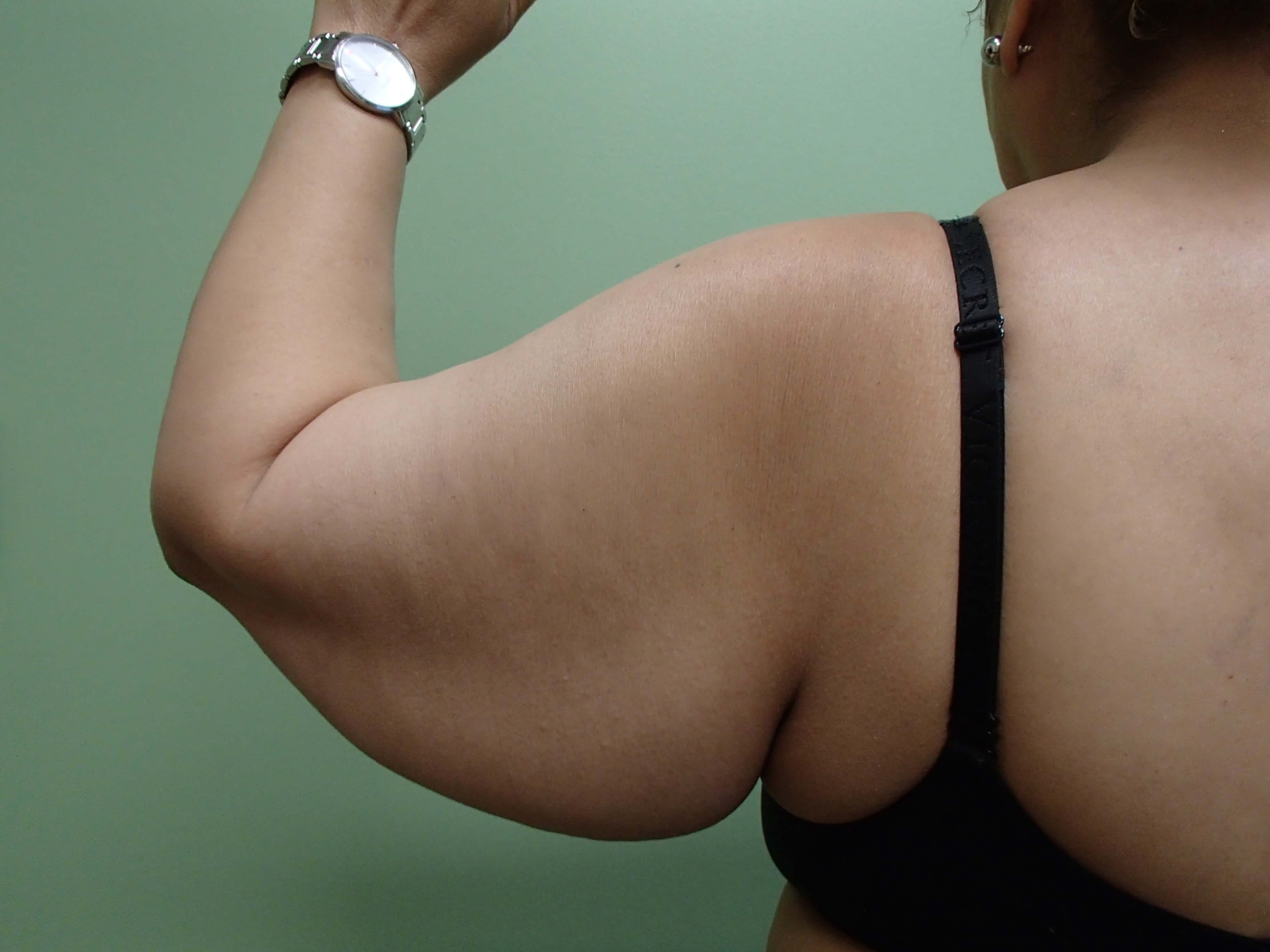 Arm Lift - Brachioplasty Before