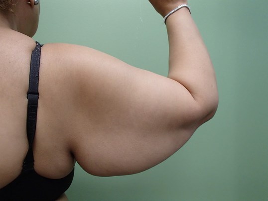 Arm Lift - Brachioplasty Before