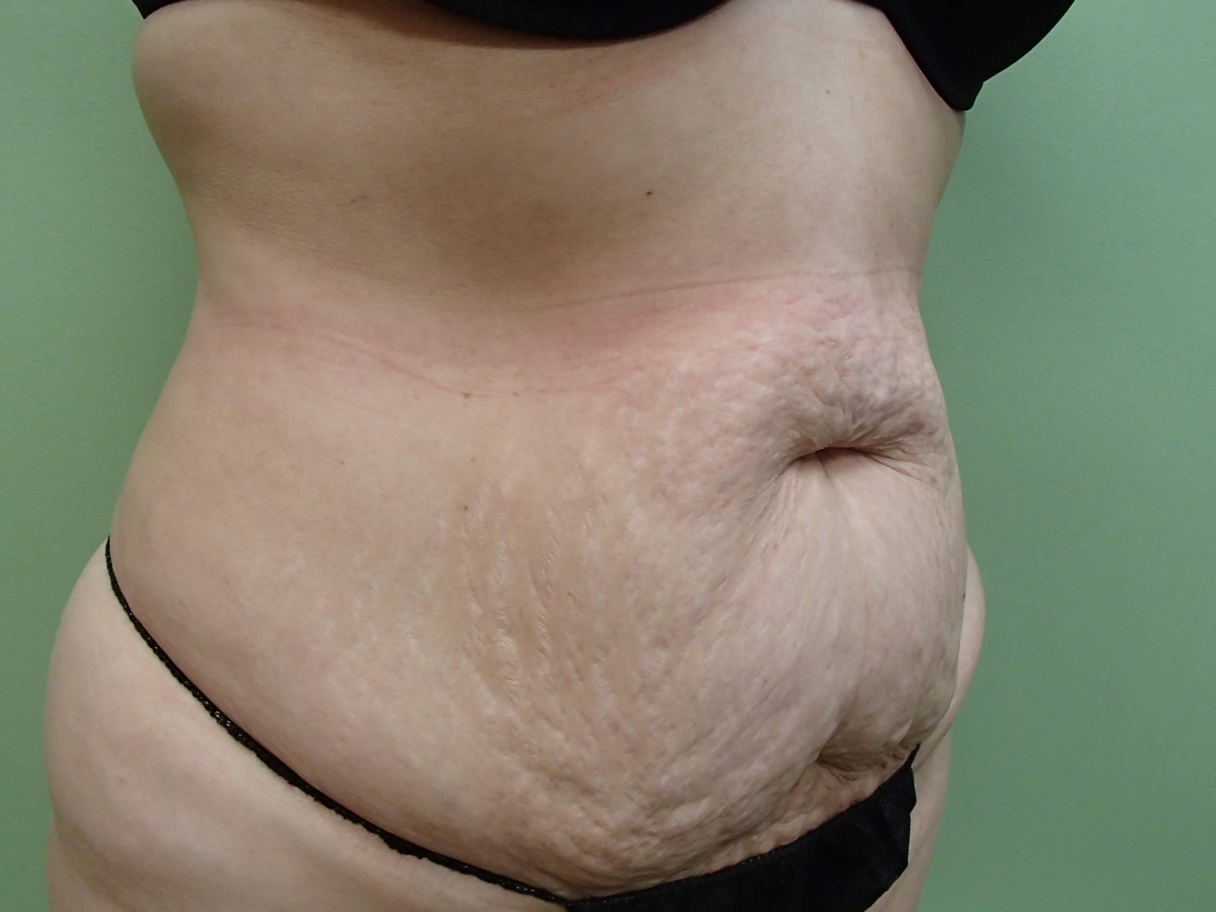 Timeless Tuck - Abdominoplasty Before