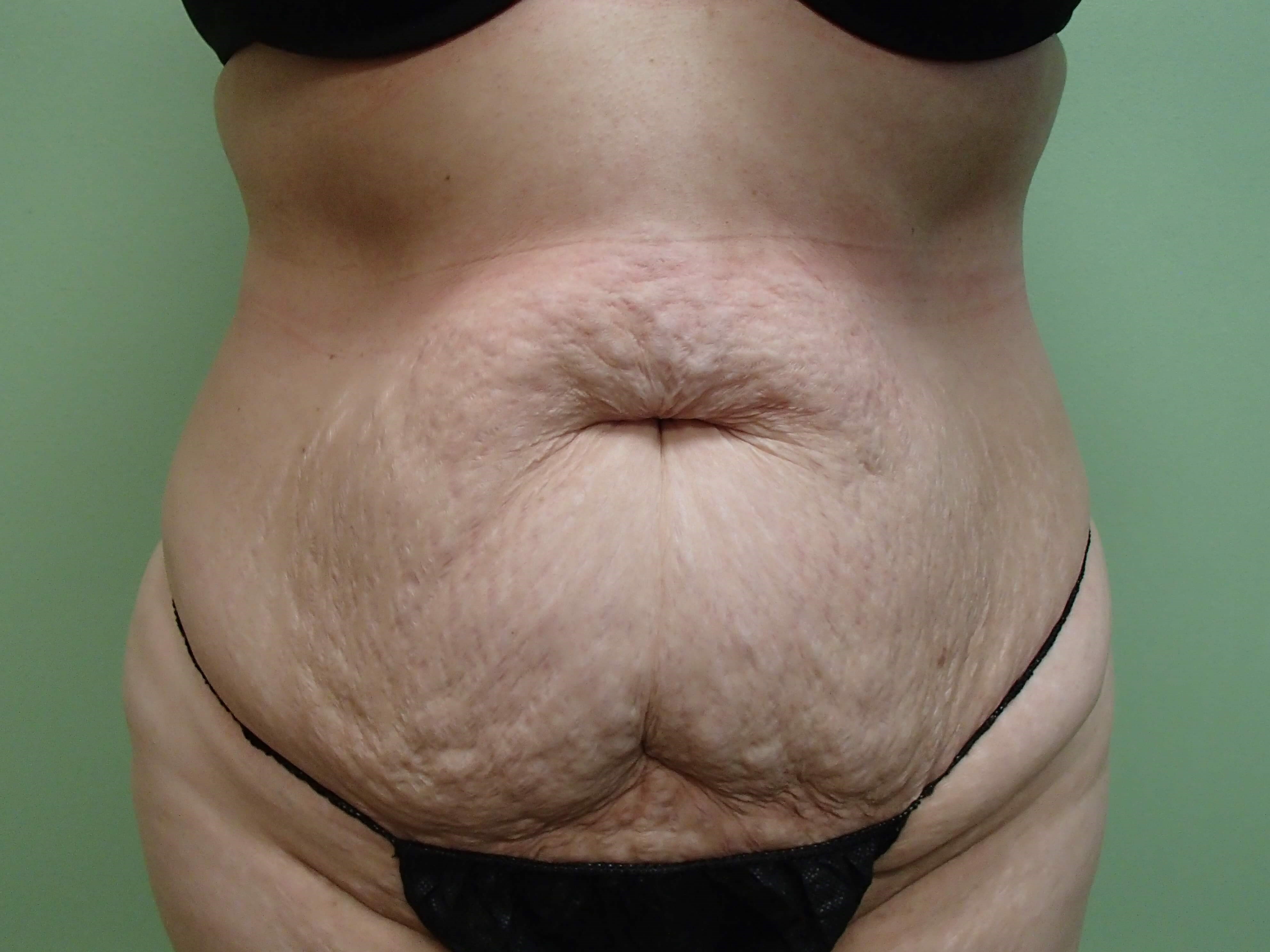 Timeless Tuck - Abdominoplasty Before