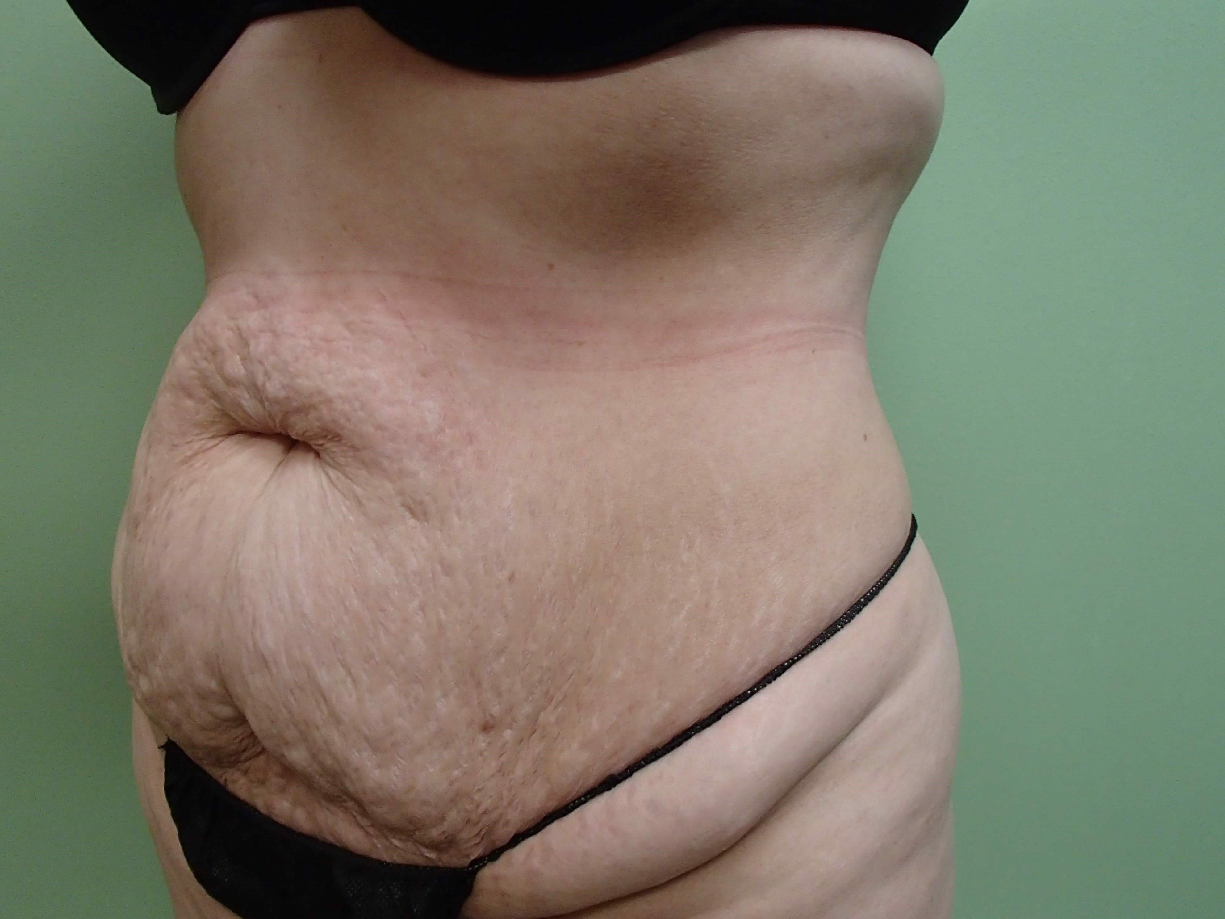 Timeless Tuck - Abdominoplasty Before