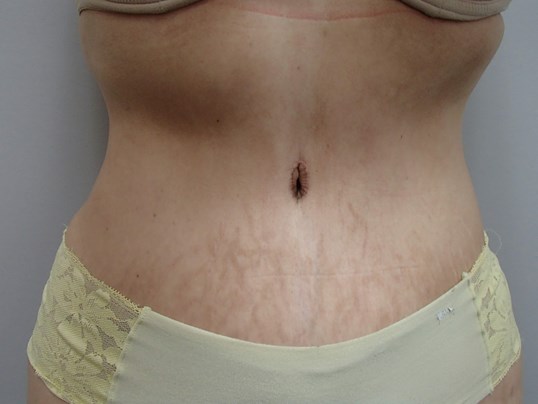 Timeless Tuck - Abdominoplasty After