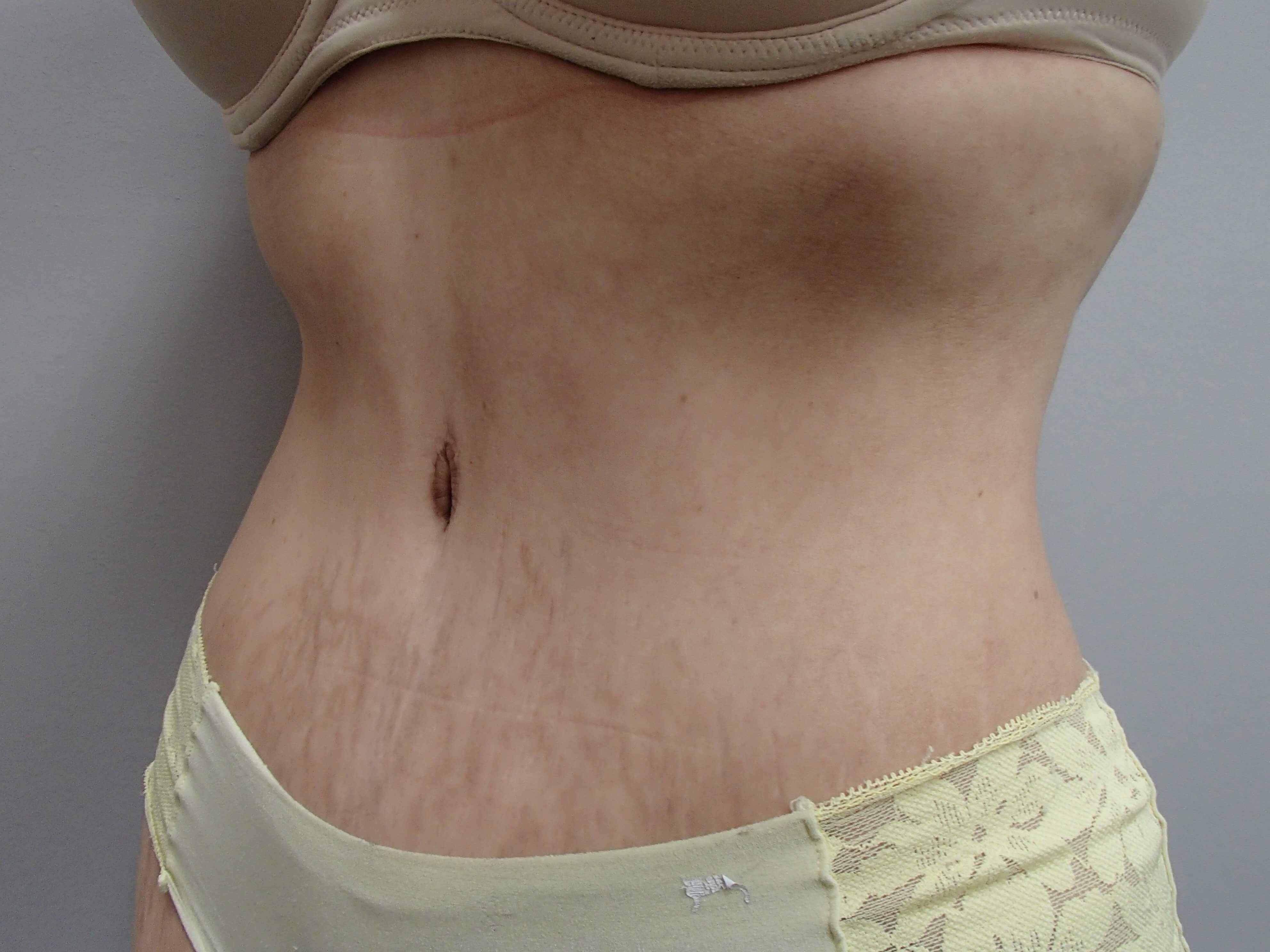 Timeless Tuck - Abdominoplasty After