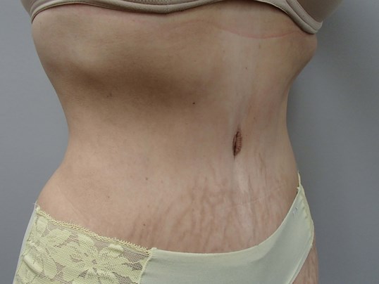 Timeless Tuck - Abdominoplasty After