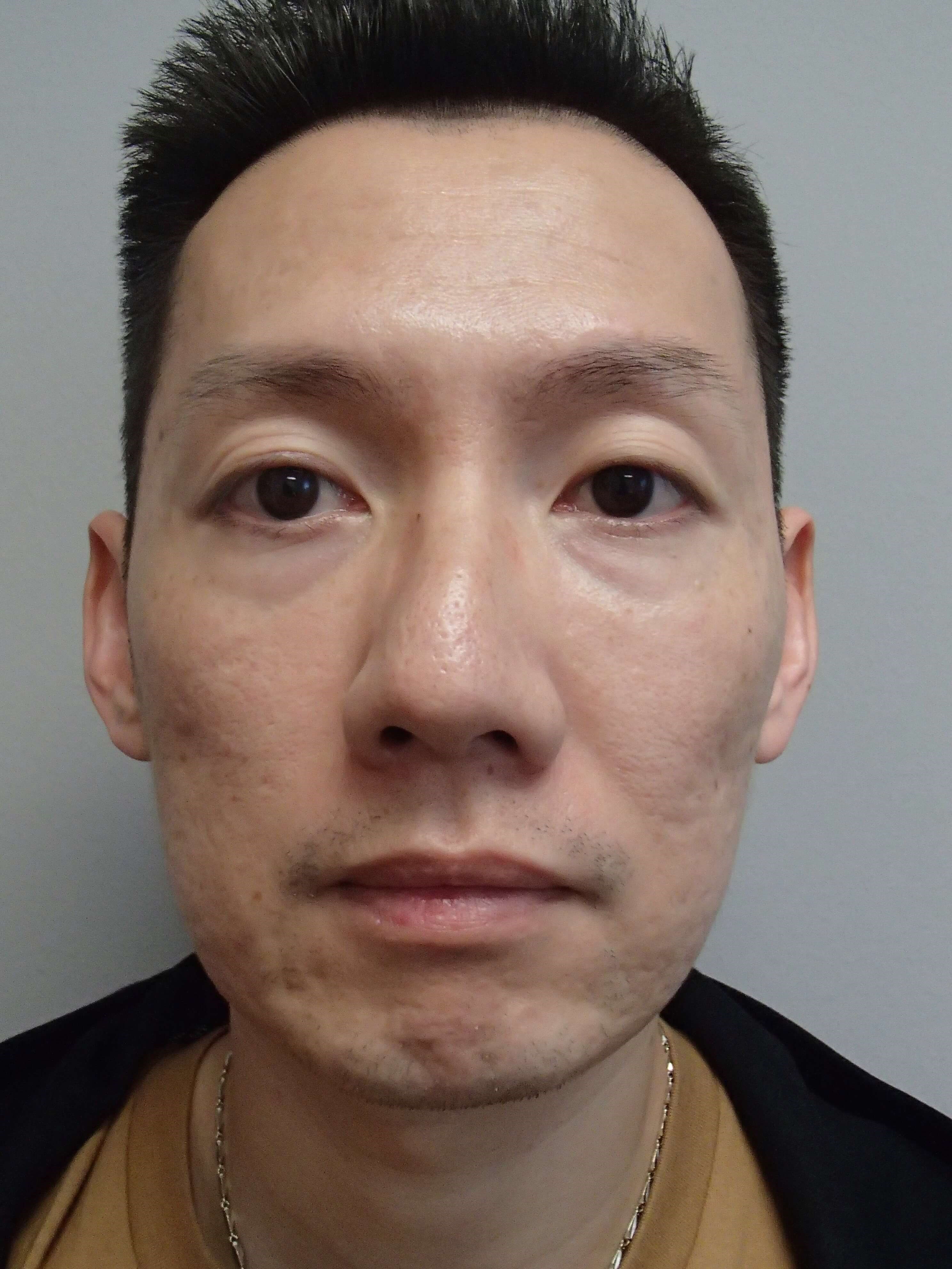 Skin Resurfacing Before