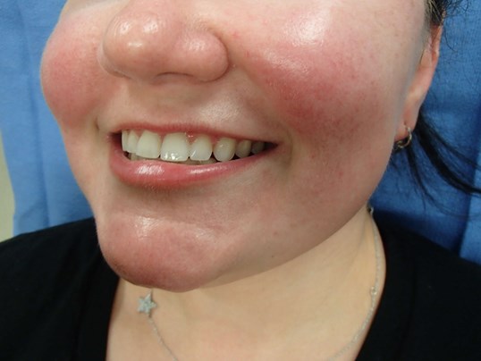 Timeless Dimple Before
