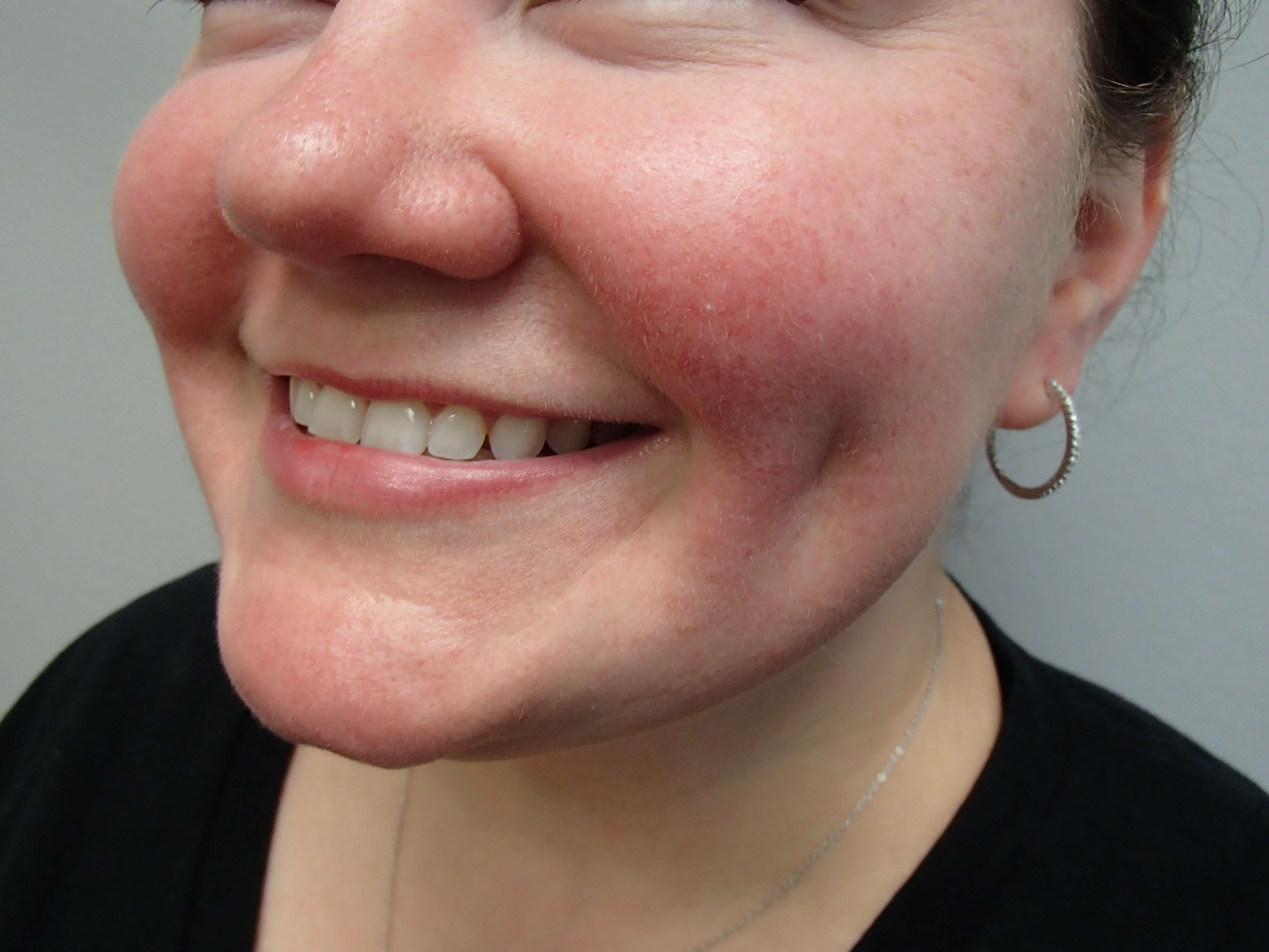 Timeless Dimple After