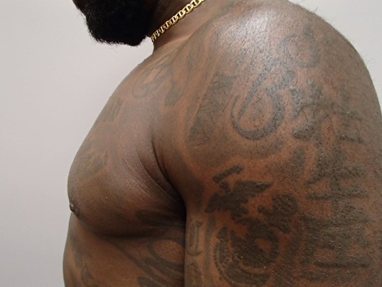 Gynecomastia Correction After