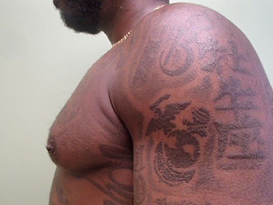 Gynecomastia Correction Before
