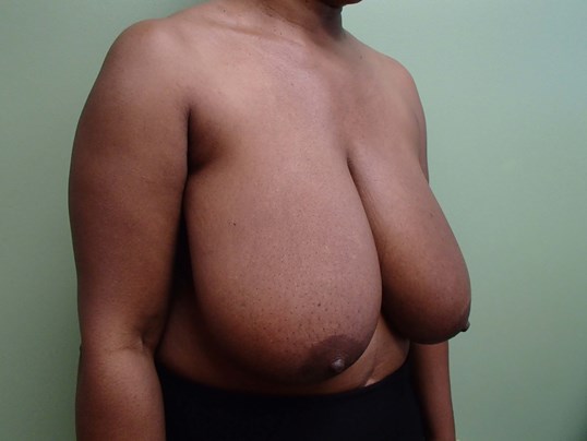 Breast Reduction Before