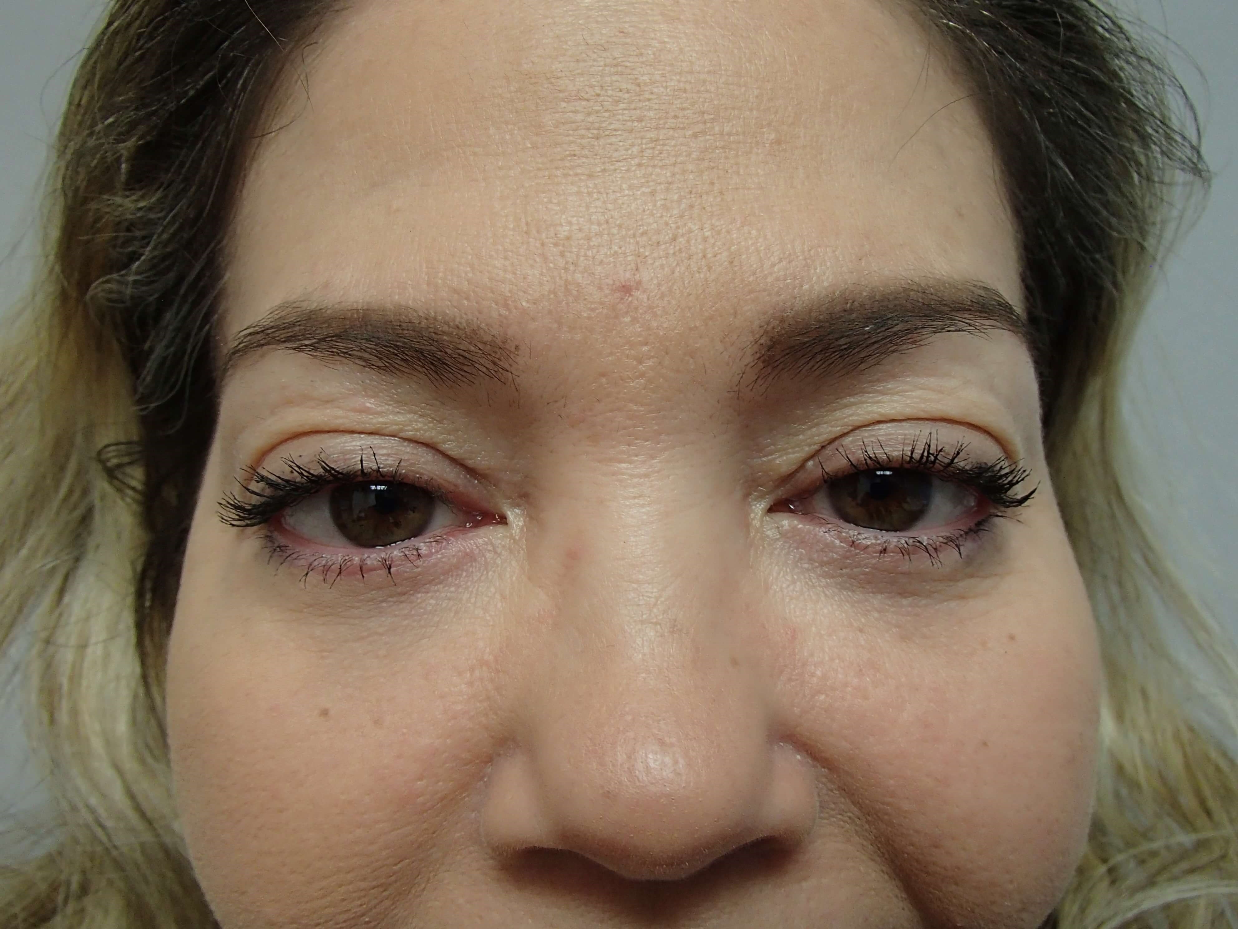 Upper and Lower Blepharoplasty After