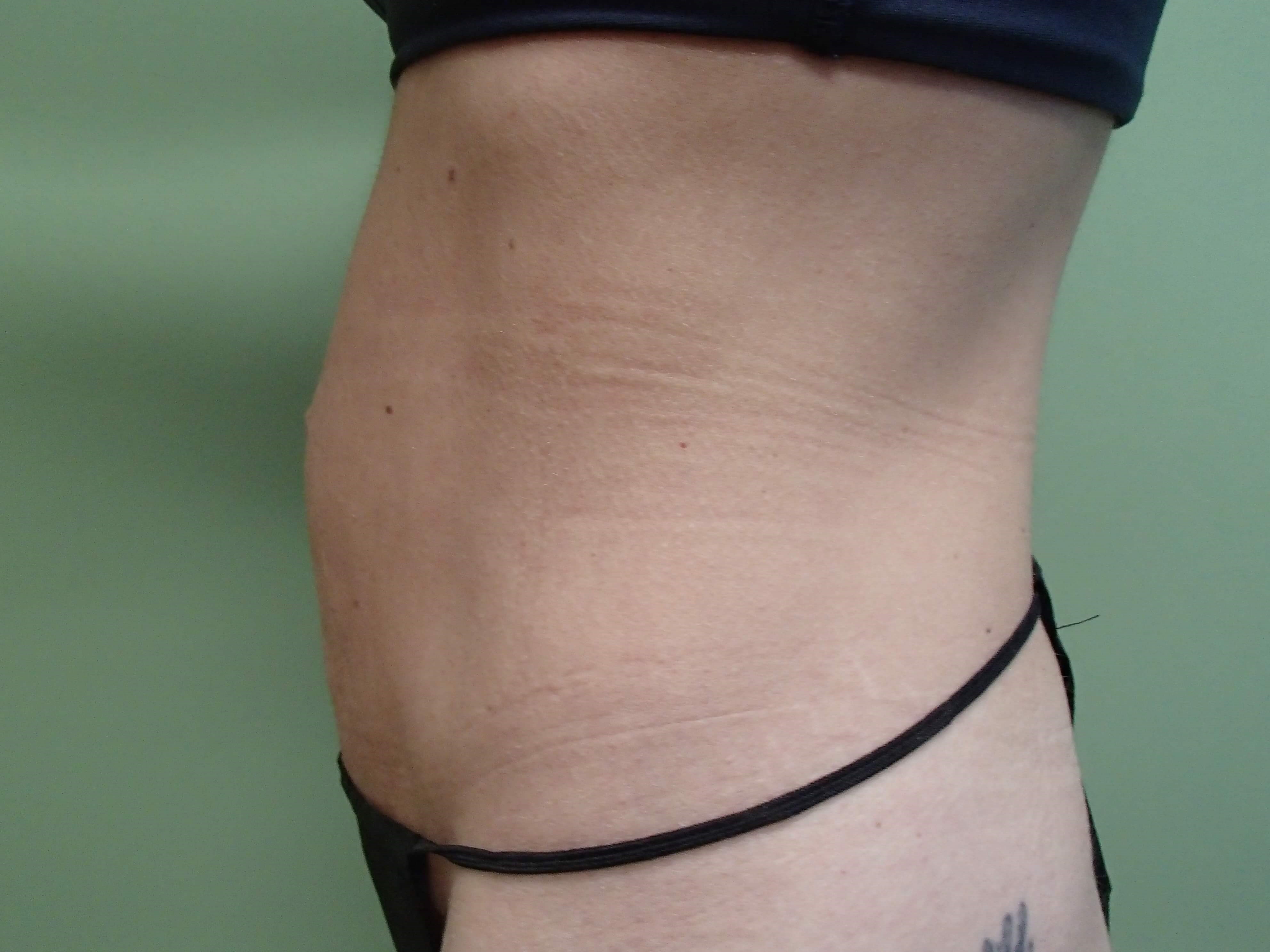 Abdominoplasty Before