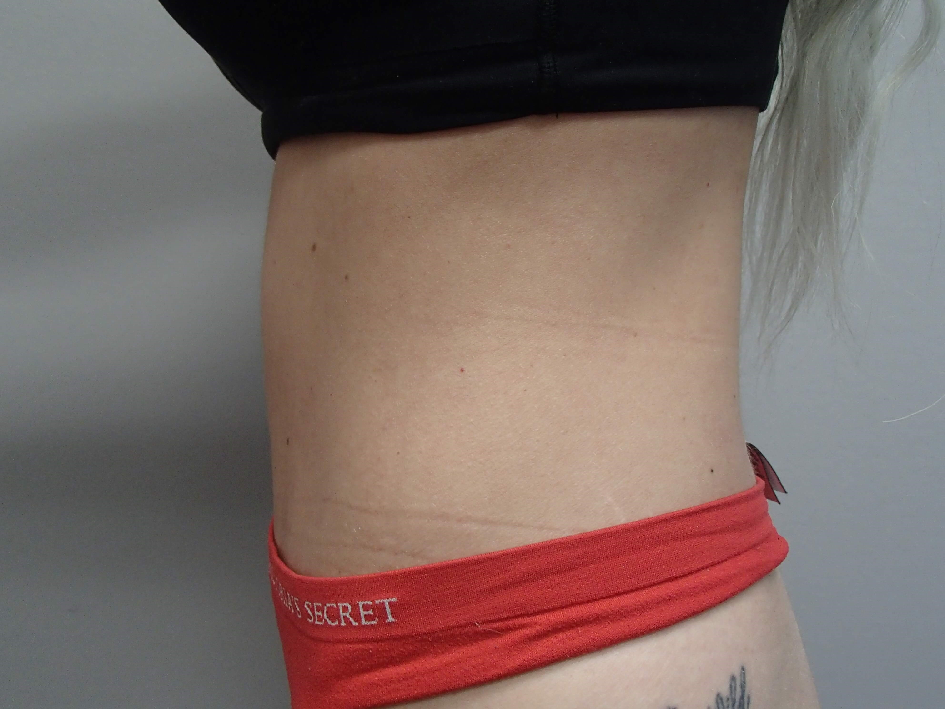 Abdominoplasty After
