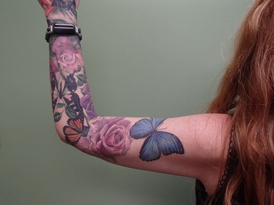 Arm Lift- Brachioplasty After