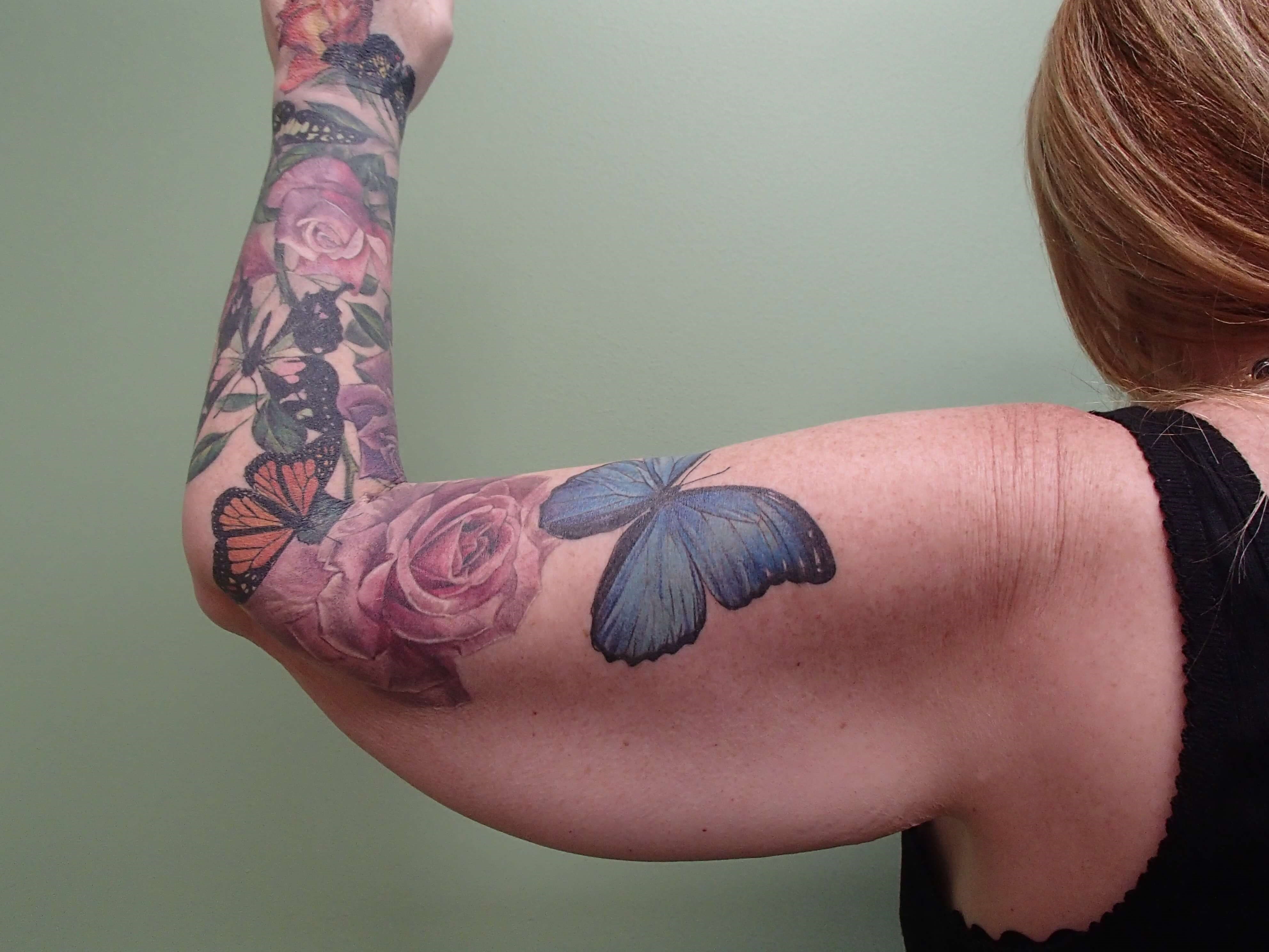 Arm Lift- Brachioplasty Before