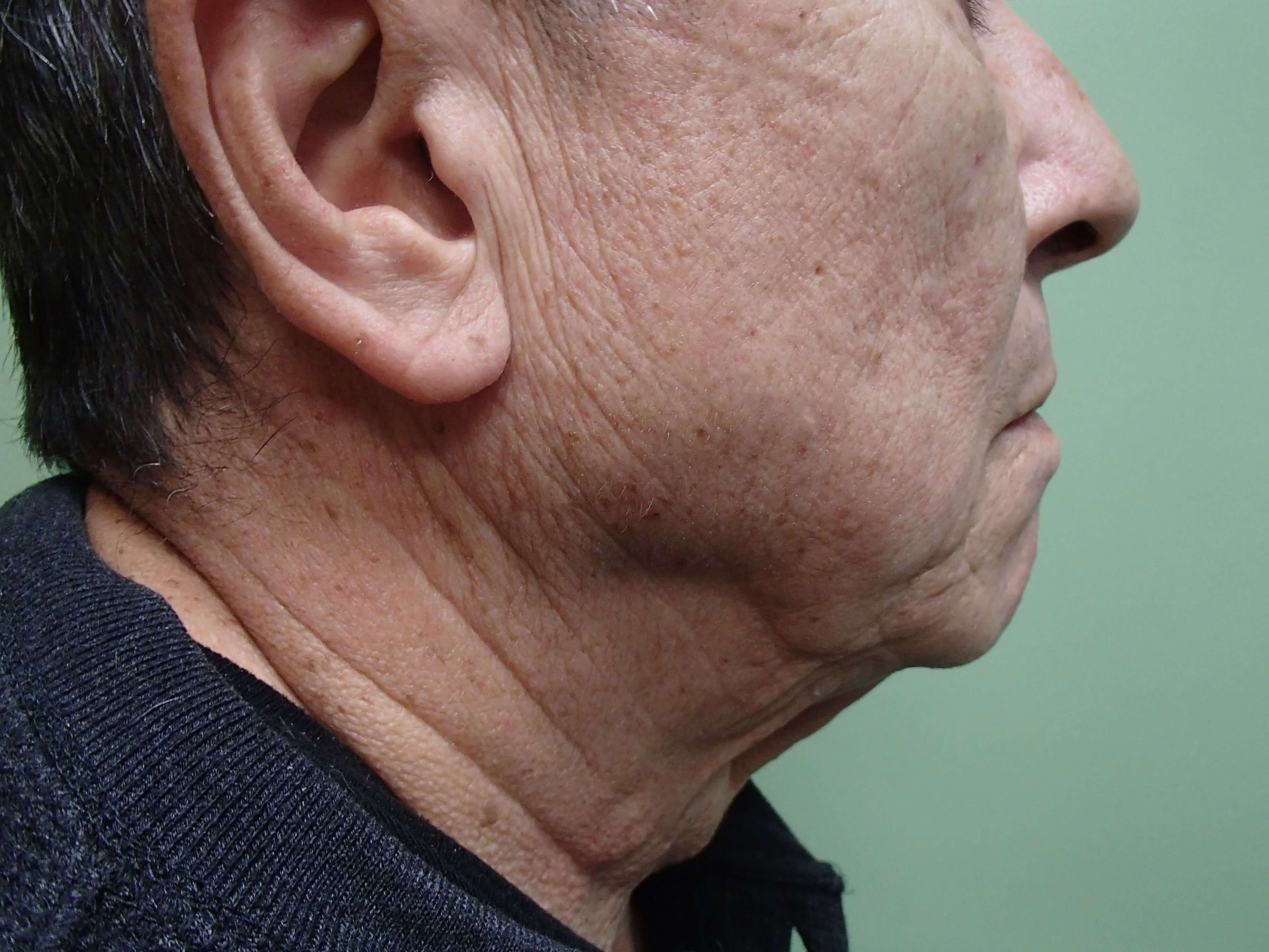 Facelift and Neck Lift Before