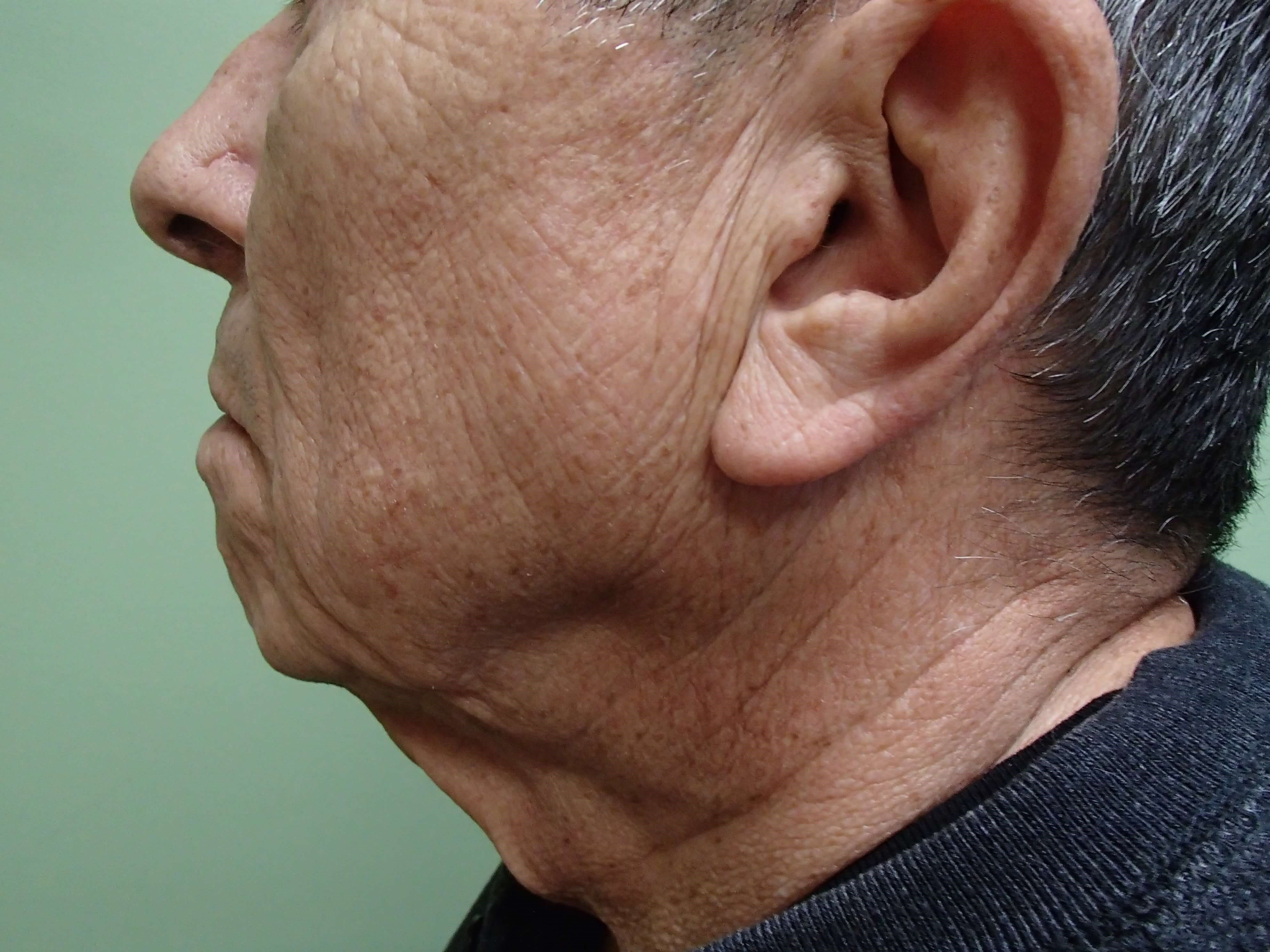 Facelift and Neck Lift Before