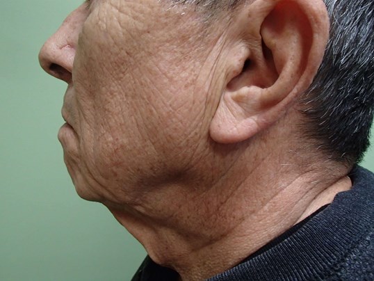 Facelift and Neck Lift Before