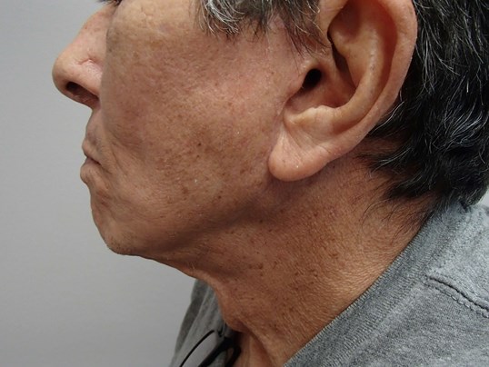 Facelift and Neck Lift After