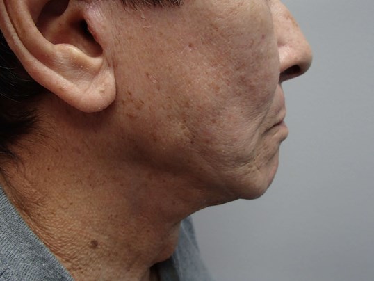 Facelift and Neck Lift After