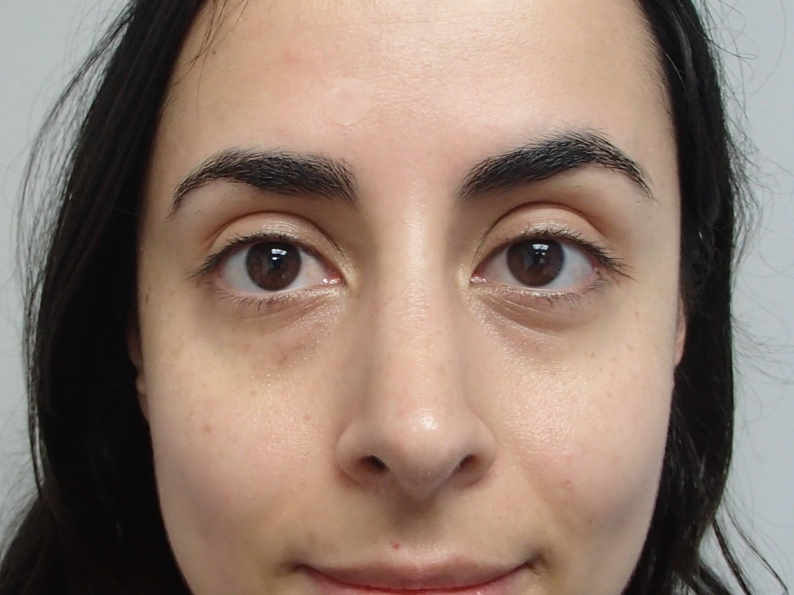 Rhinoplasty (Nose Job) After