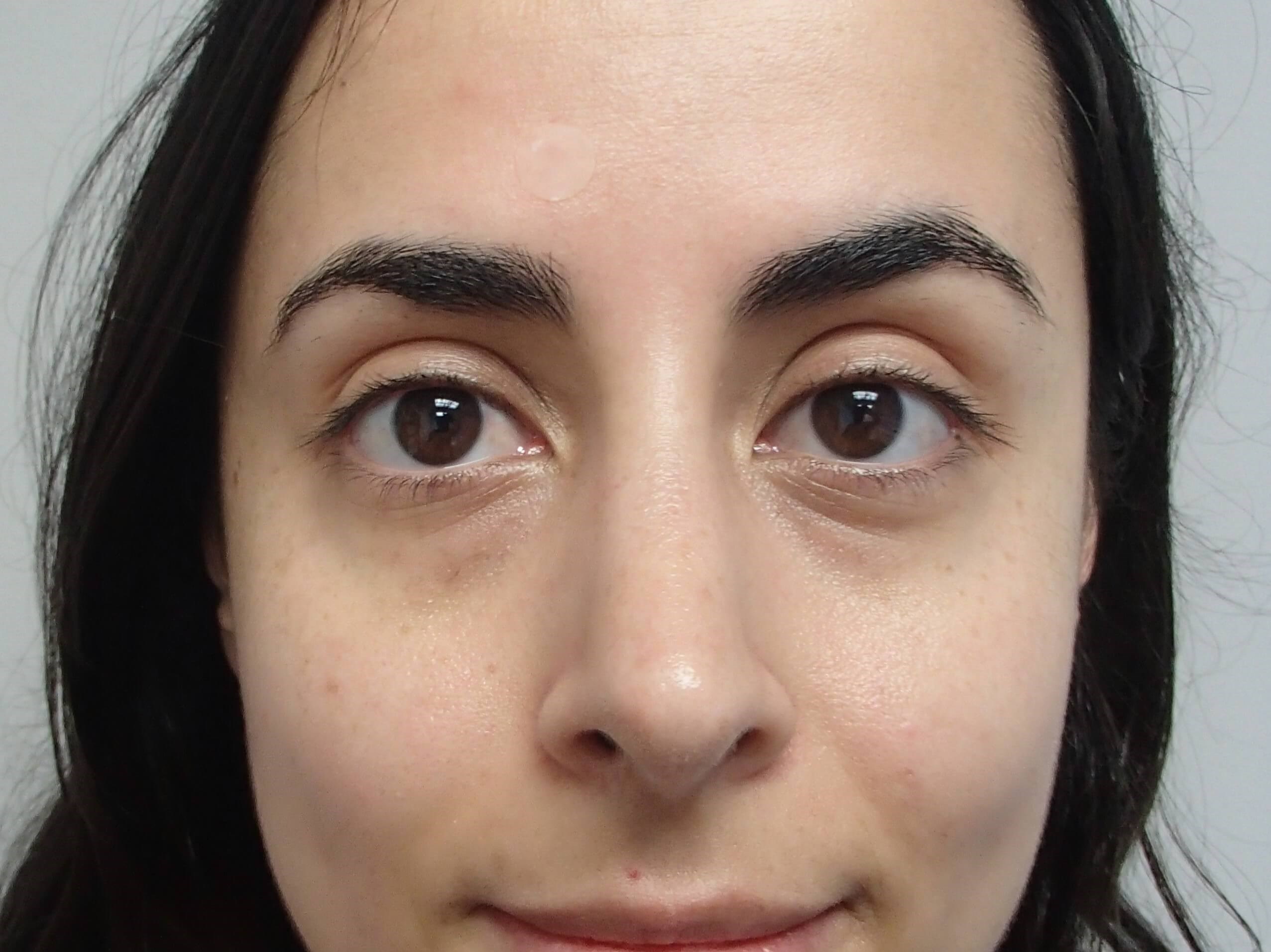 Rhinoplasty (Nose Job) After