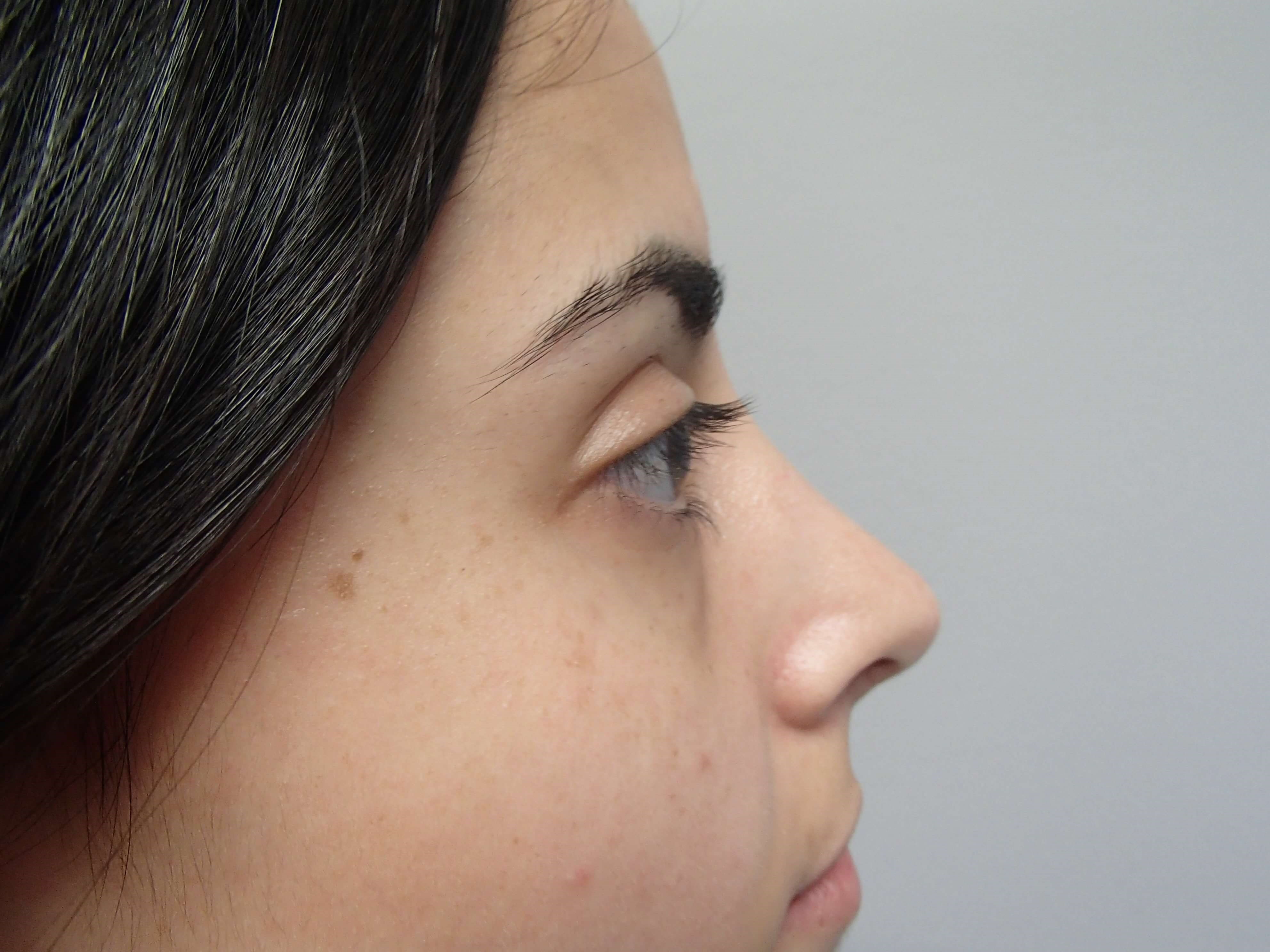 Rhinoplasty (Nose Job) After
