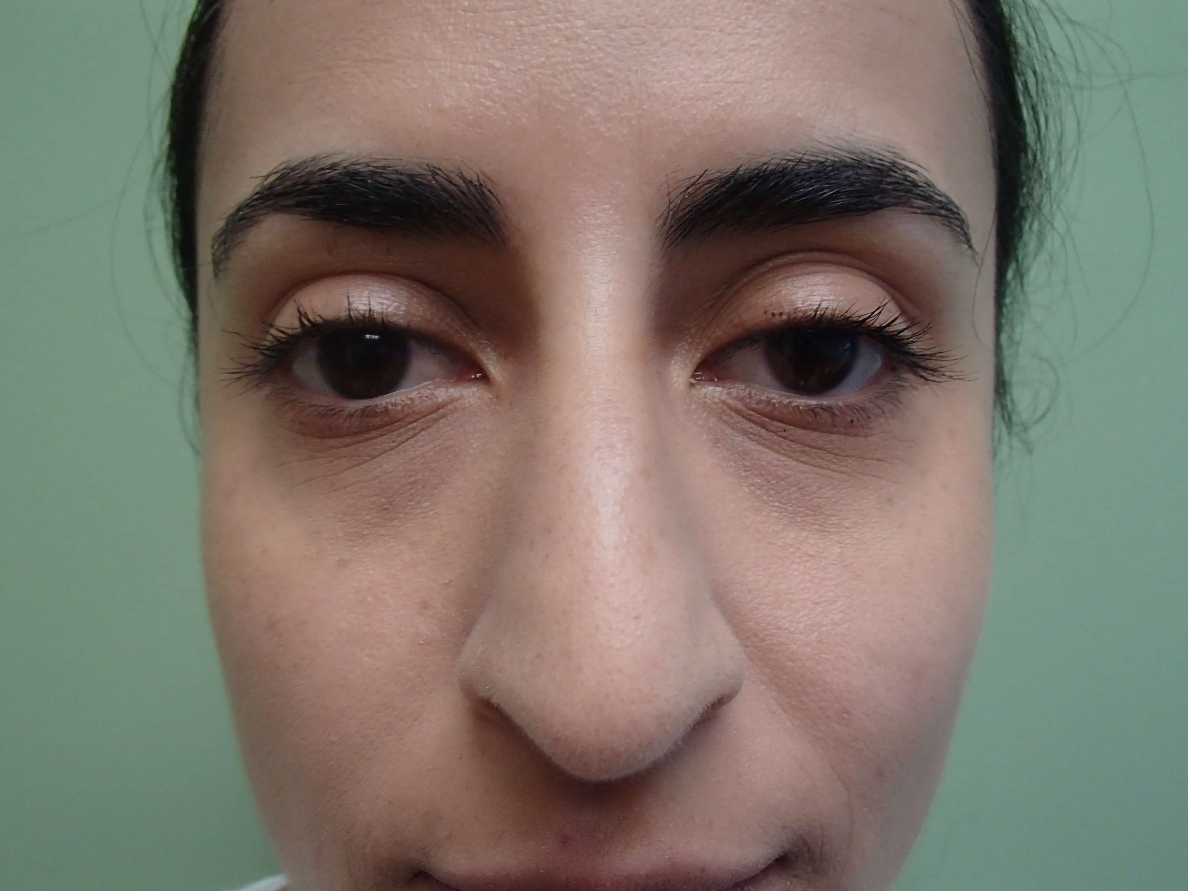 Rhinoplasty (Nose Job) Before