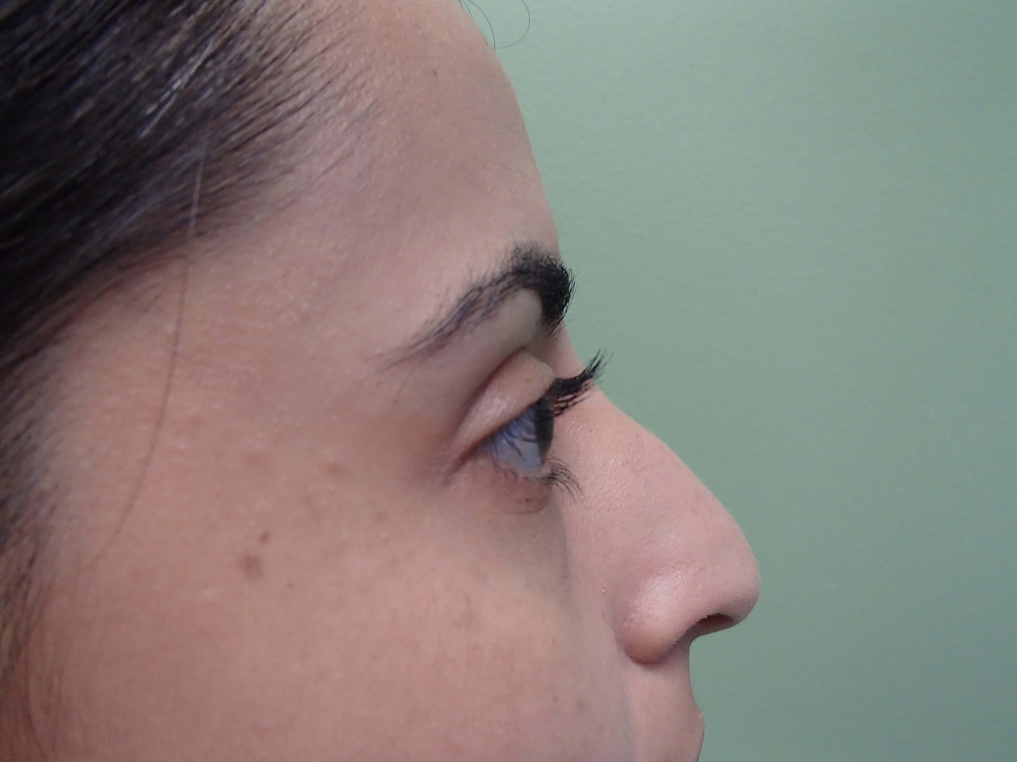 Rhinoplasty (Nose Job) Before